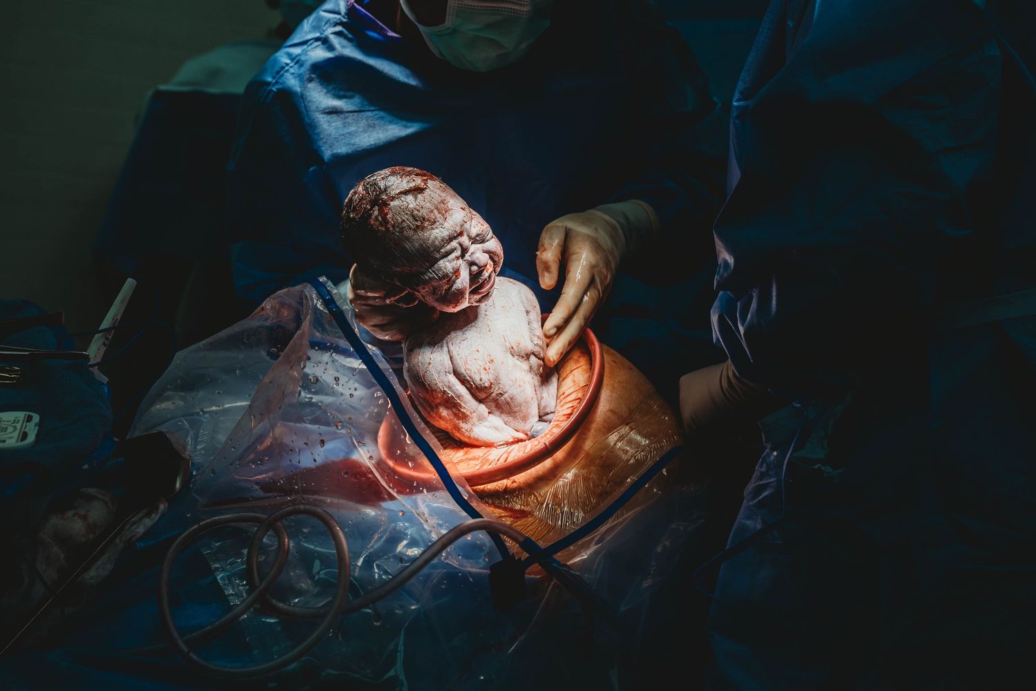 Newborn baby emerging during a cesarean birth in an operating room, held gently by a surgeon in dramatic spotlight.