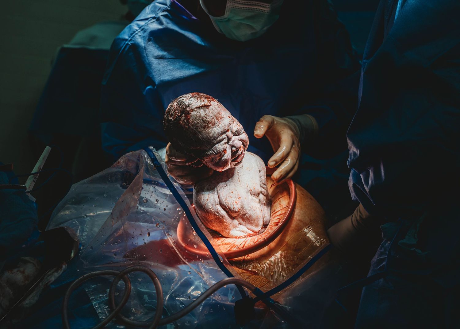 Medical professionals performing a cesarean section delivery in an operating room, with a newborn baby emerging.