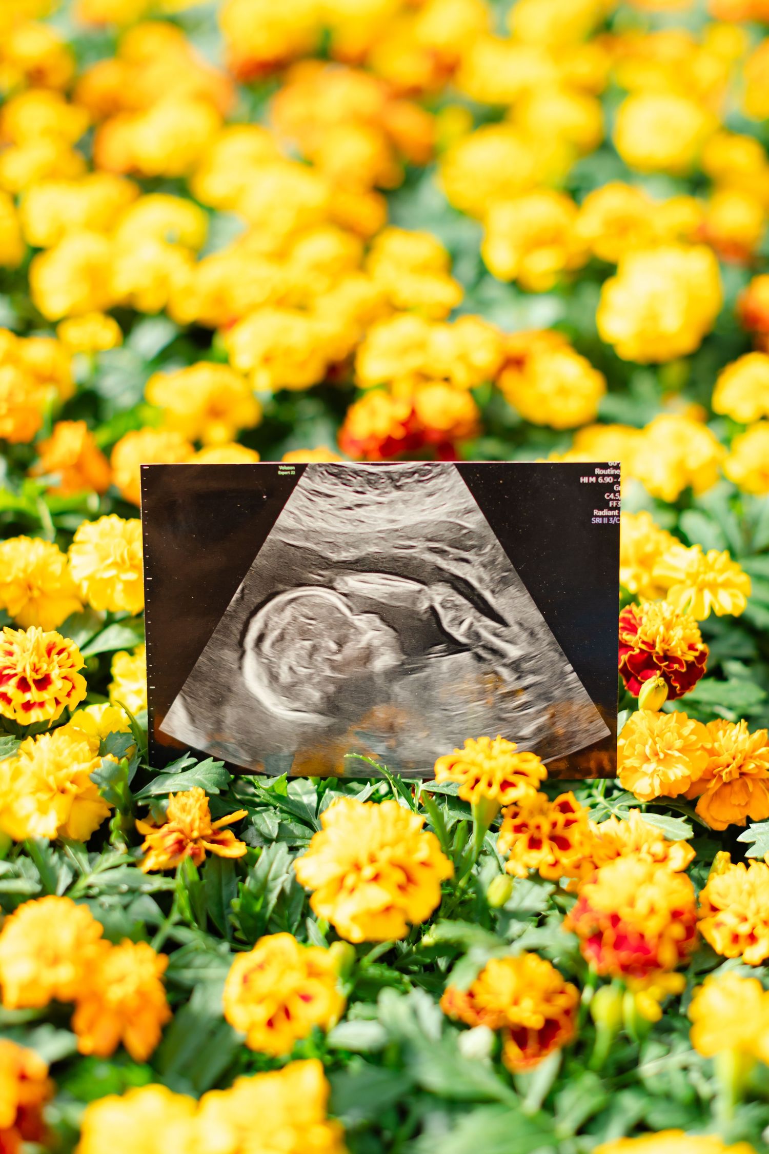 Ultrasound scan images placed among vibrant yellow and orange marigold flowers with green foliage in garden setting.