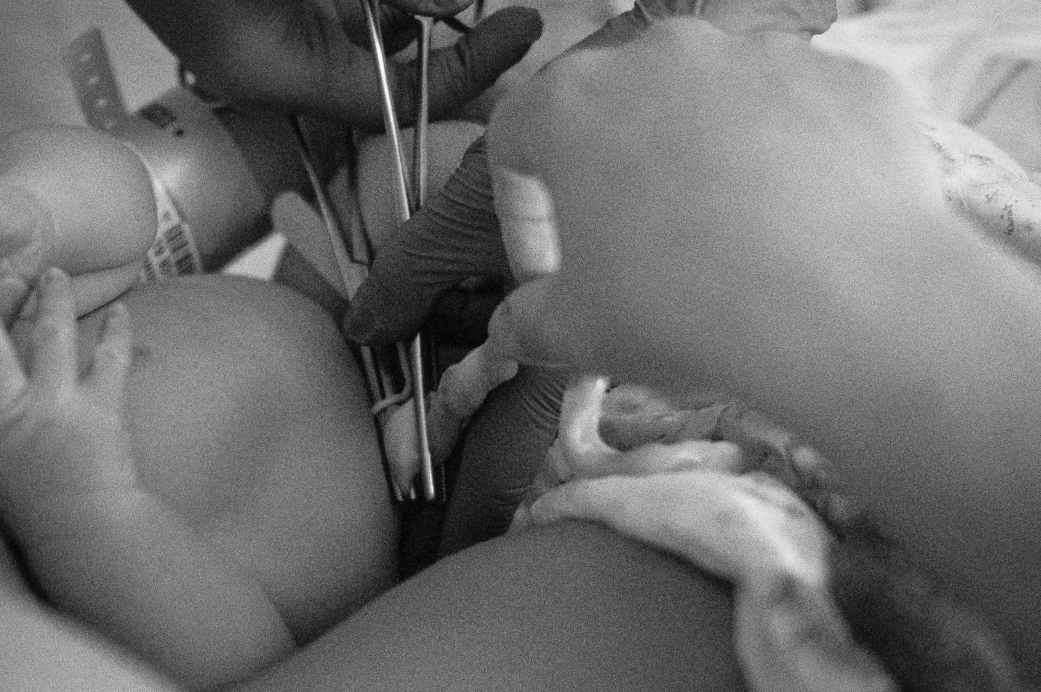 Svartvit förlossningsfotografering i Skåne med nyfödd bebis precis efter födseln i sjukhusmiljö.