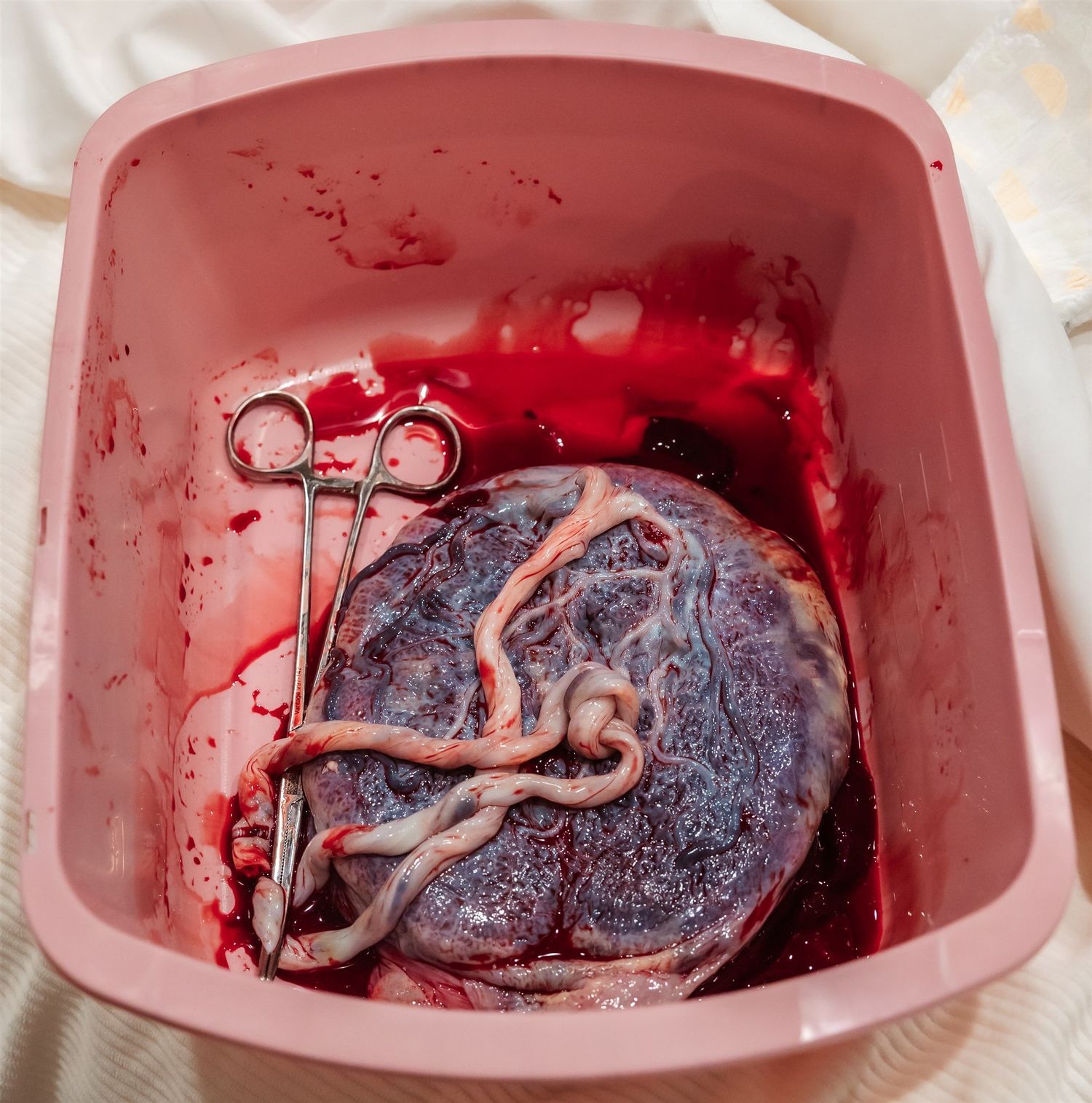 true knot in placenta