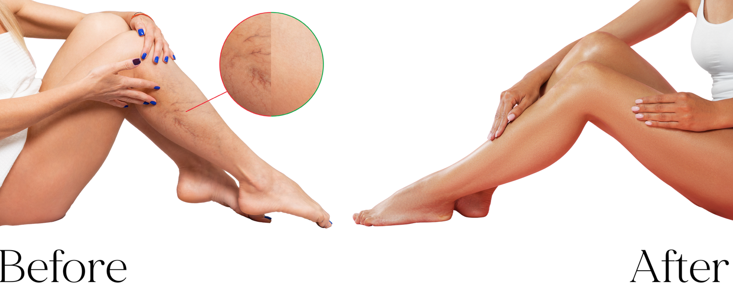 Before and after spider vein removal treatment on legs showing clear skin transformation results.