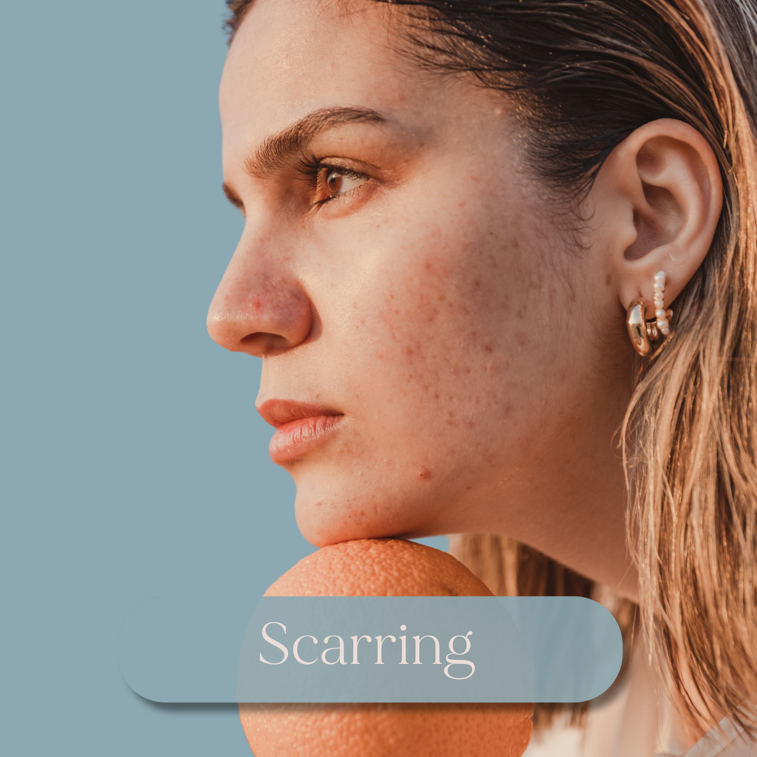 A young woman with acne scarring on her skin shown in profile against a soft blue background.