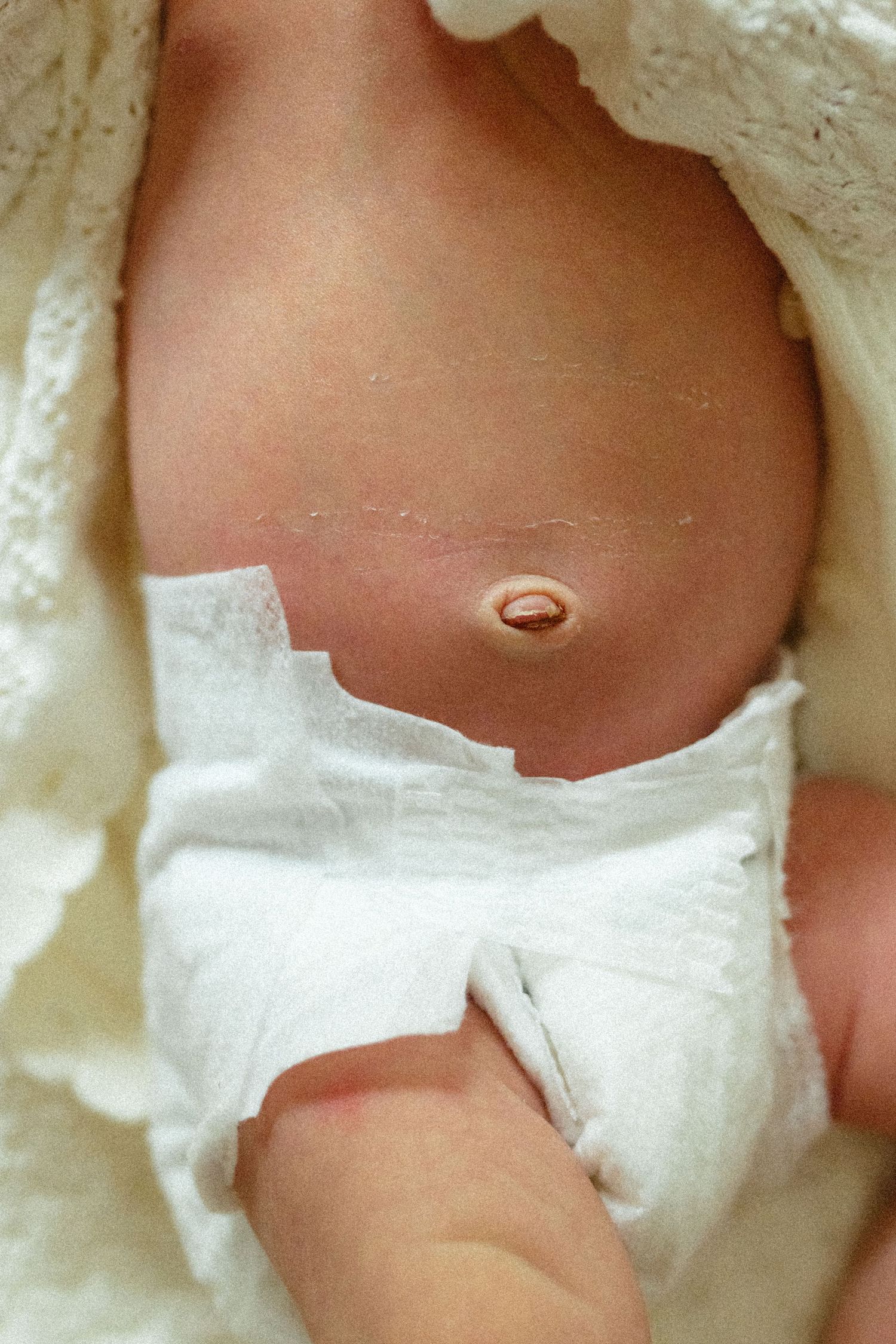 Close-up of newborn babys belly button with umbilical cord stump in diaper.