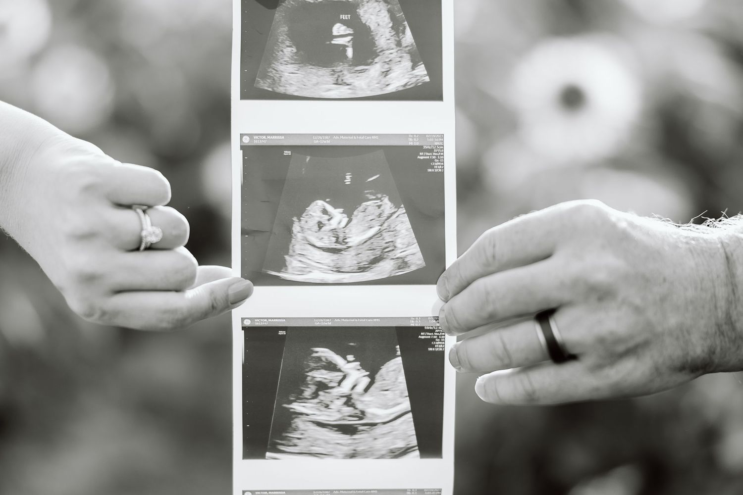 Hands holding three ultrasound sonogram photos showing the development of a baby in the womb.