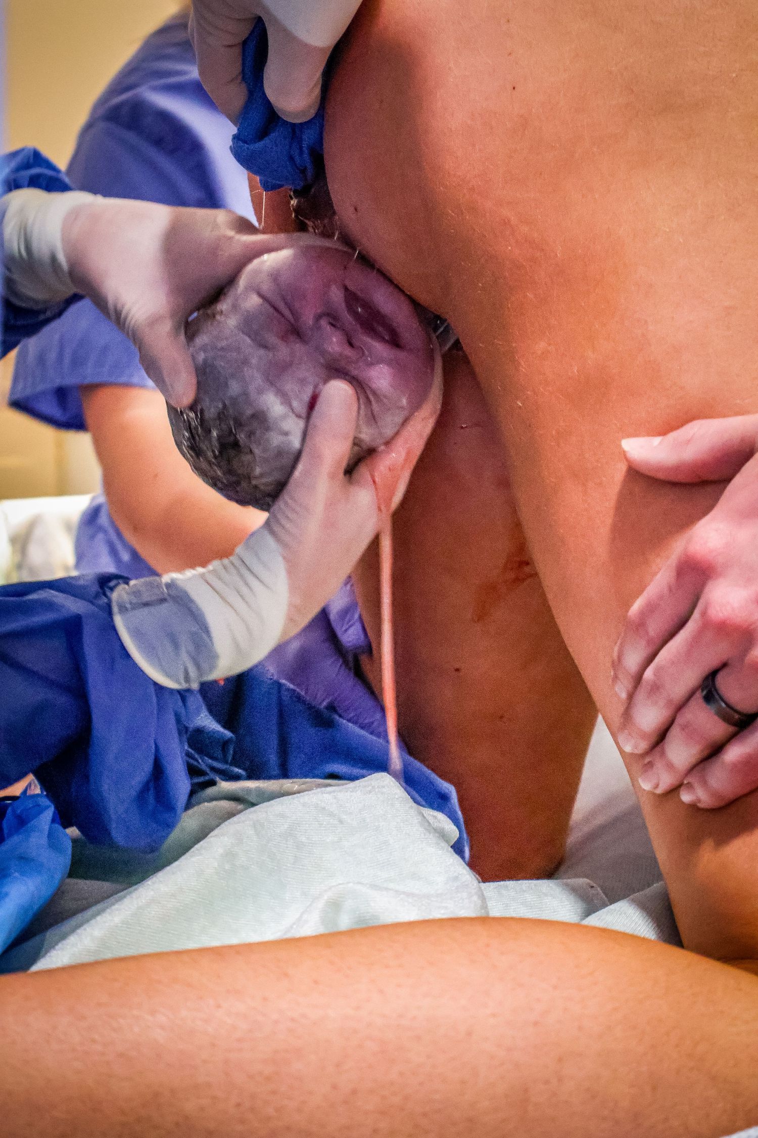 Healthcare workers performing medical procedures in delivery room setting.