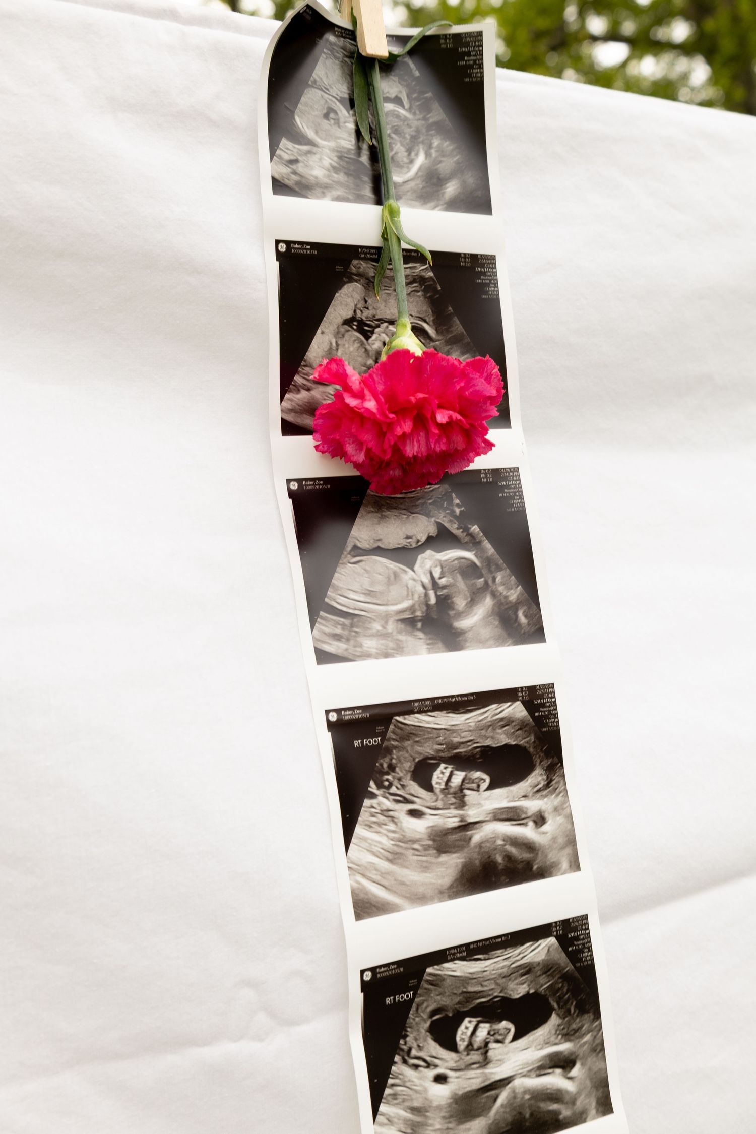 Ultrasound photos arranged vertically with a red carnation flower.
