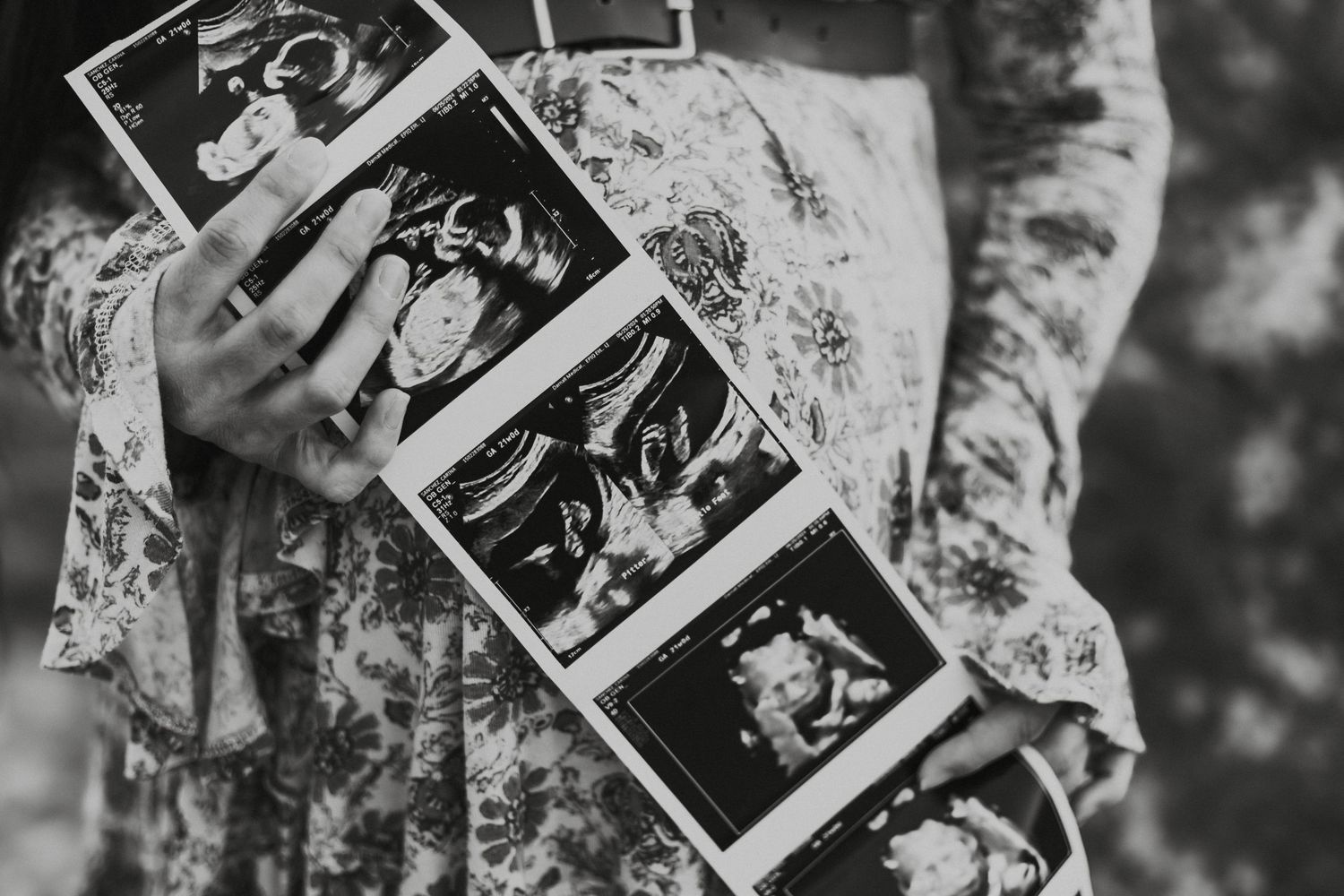 Black and white image of ultrasound photos arranged in sequence on floral fabric.