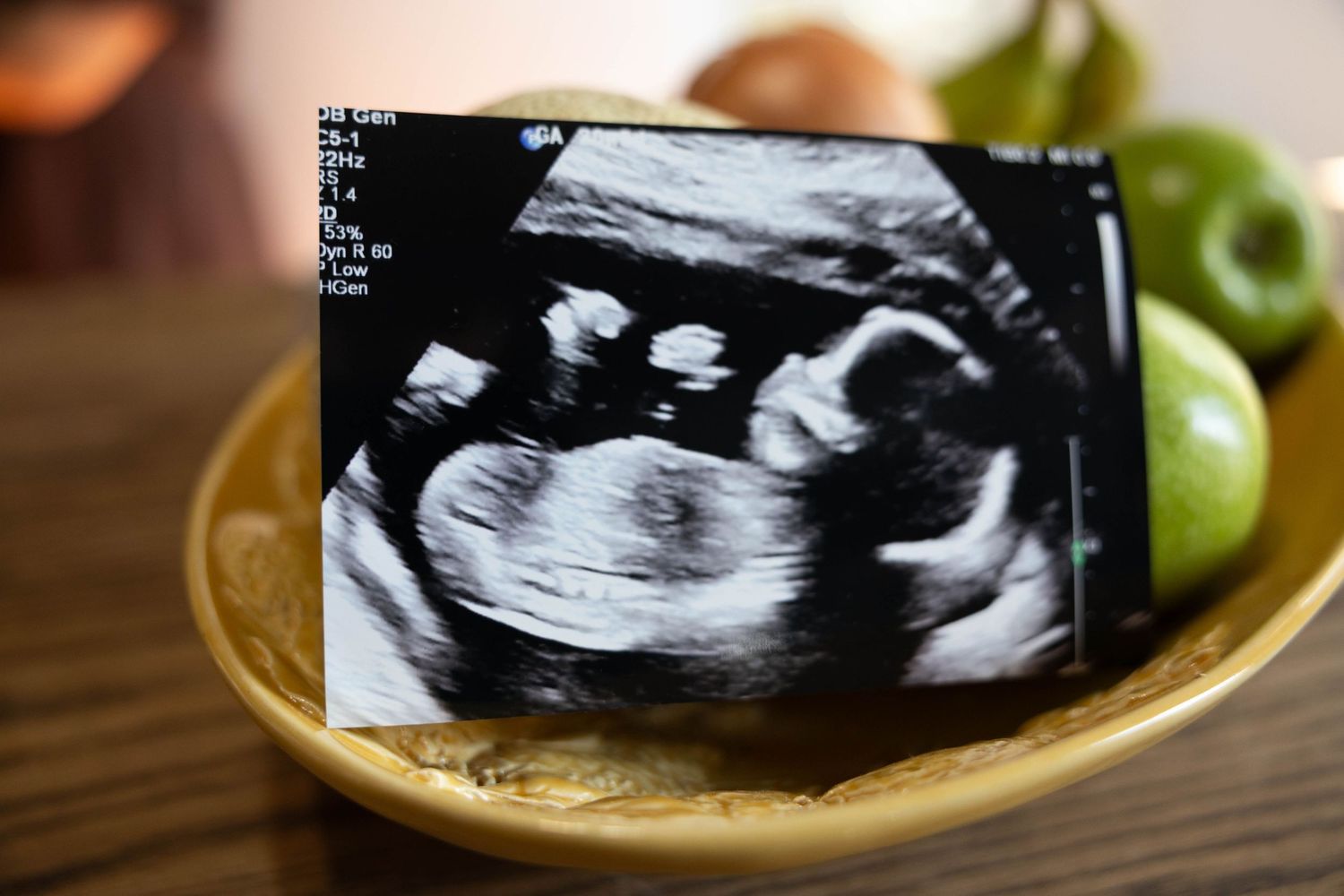 A series of ultrasound sonogram images arranged in a row showing different stages of fetal development.