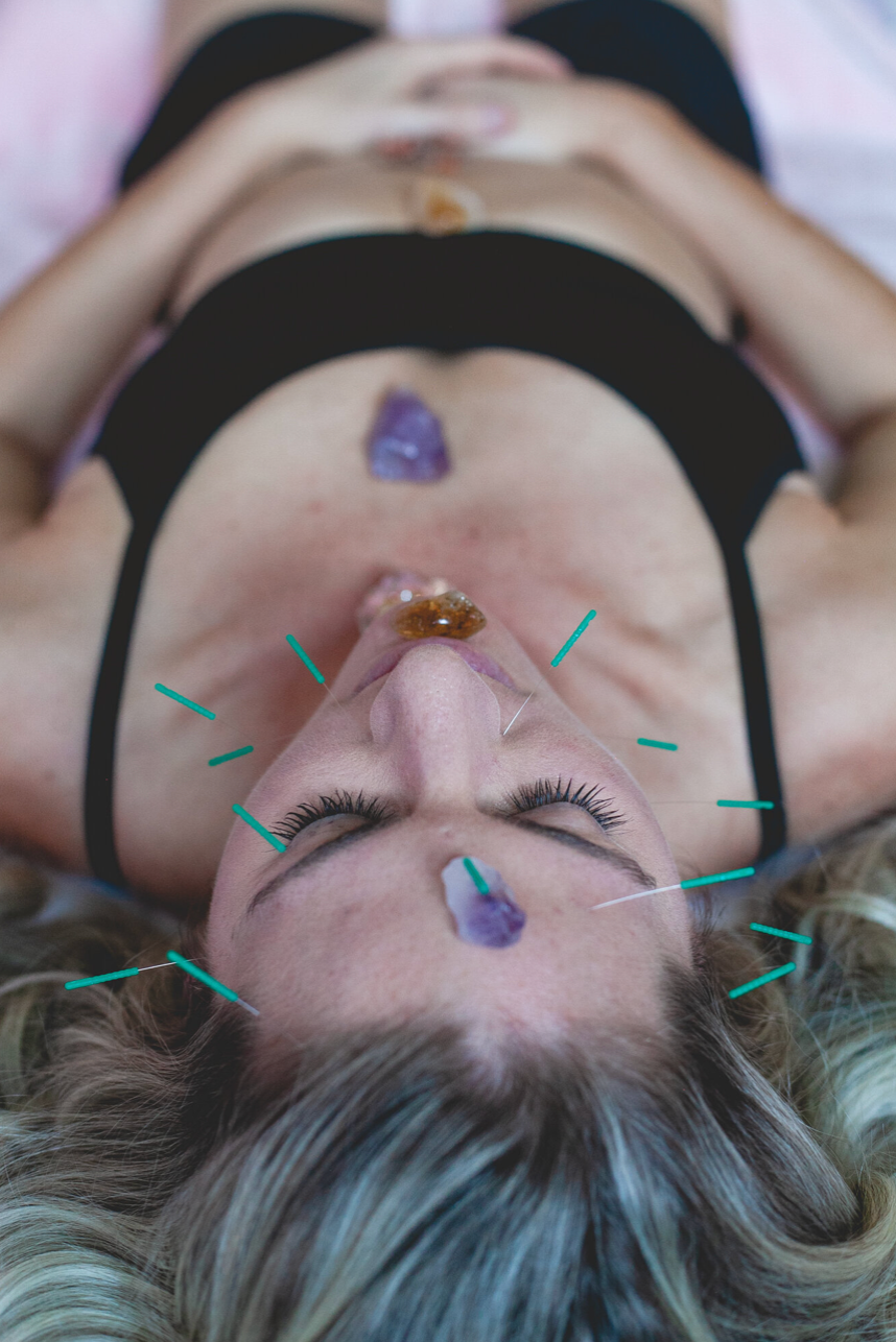 Acupuncture and crystal healing session with turquoise needles and purple stones.
