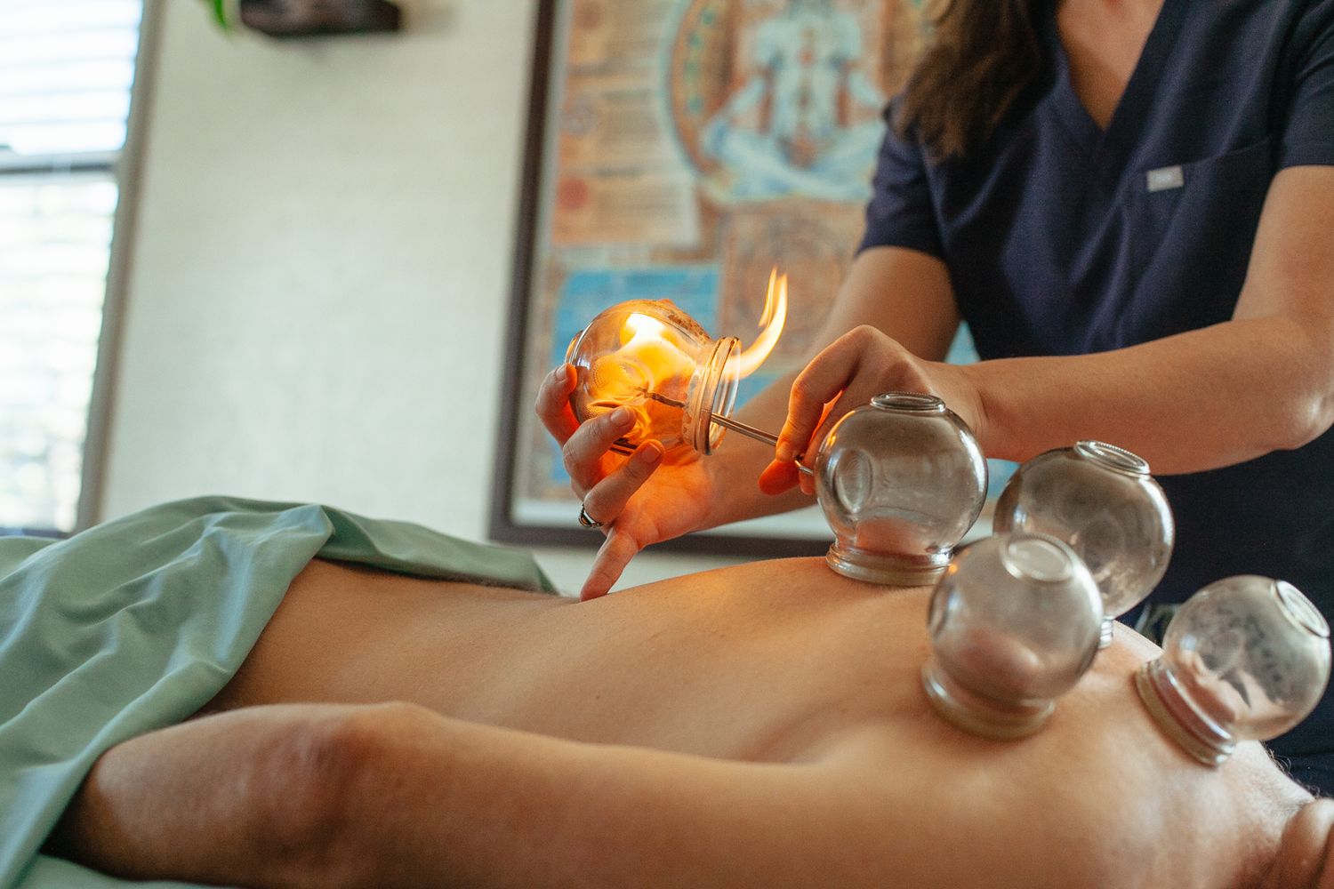 Glass cupping therapy being performed with flames heating traditional glass cups.