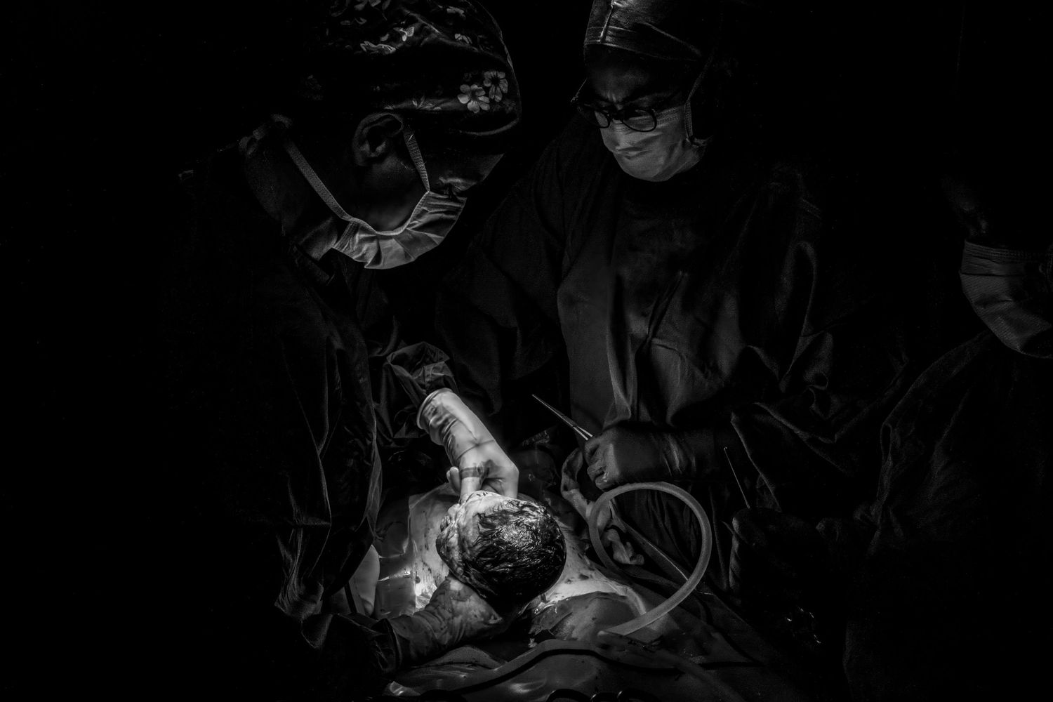 Black and white photo of surgeons in scrubs and masks performing a medical procedure under bright operating room lights.