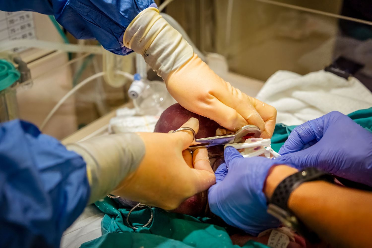 Medical team performing surgery, with gloved hands using surgical instruments on a patient in an operating room.