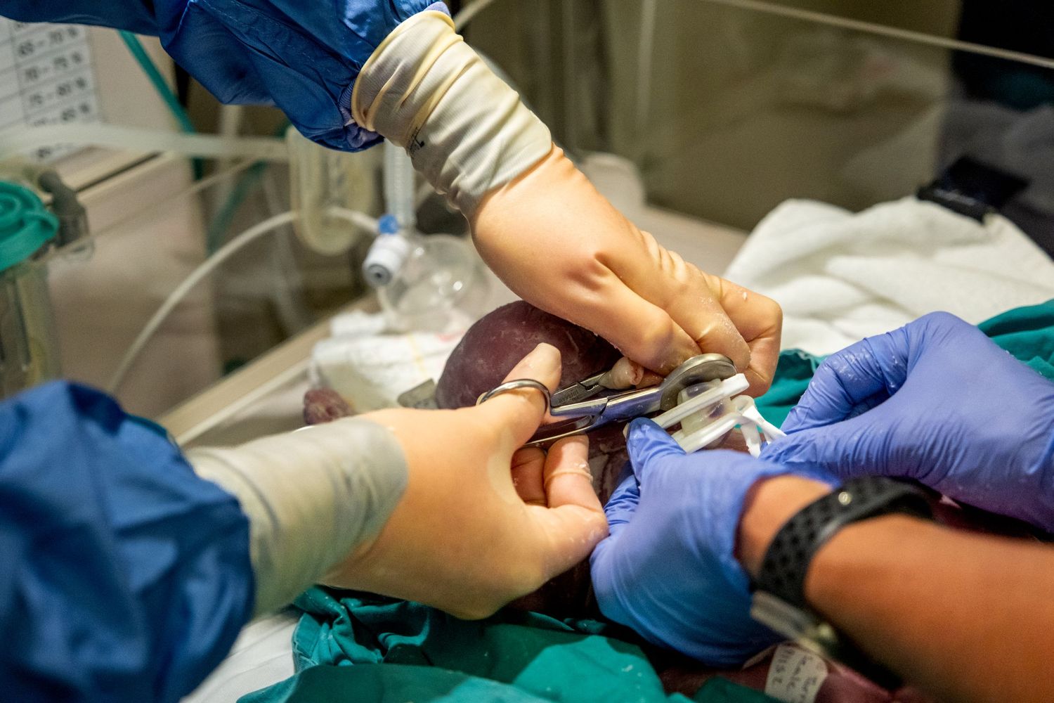 Medical professionals in blue gloves cutting the umbilical cord of a newborn in delivery room.