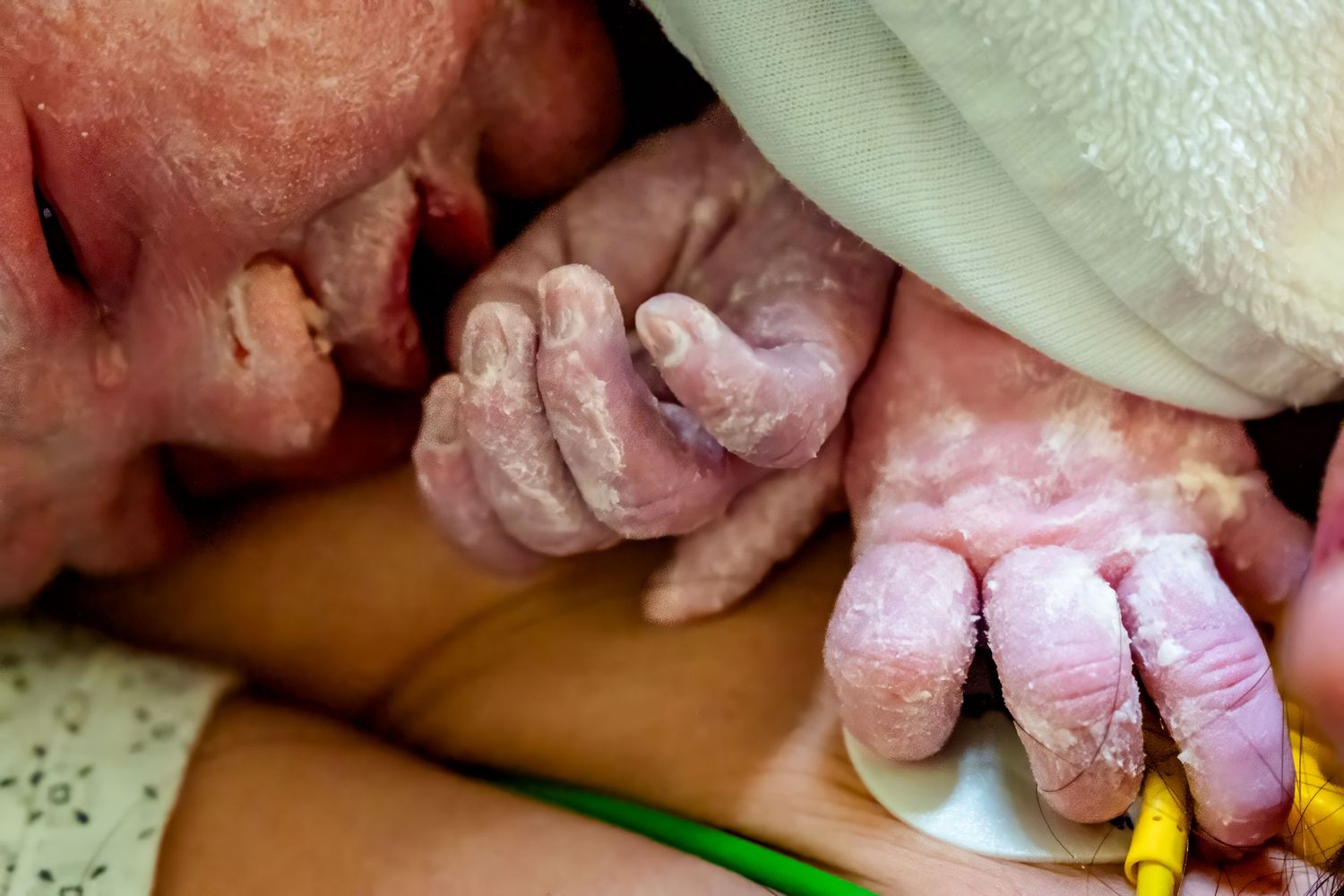 Newborn baby hands and feet covered in vernix caseosa shortly after birth in hospital delivery room.