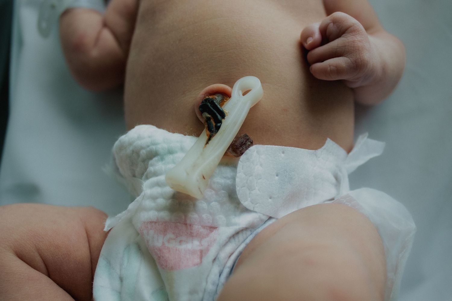 Newborn baby in diaper with umbilical cord clamp in hospital after birth.