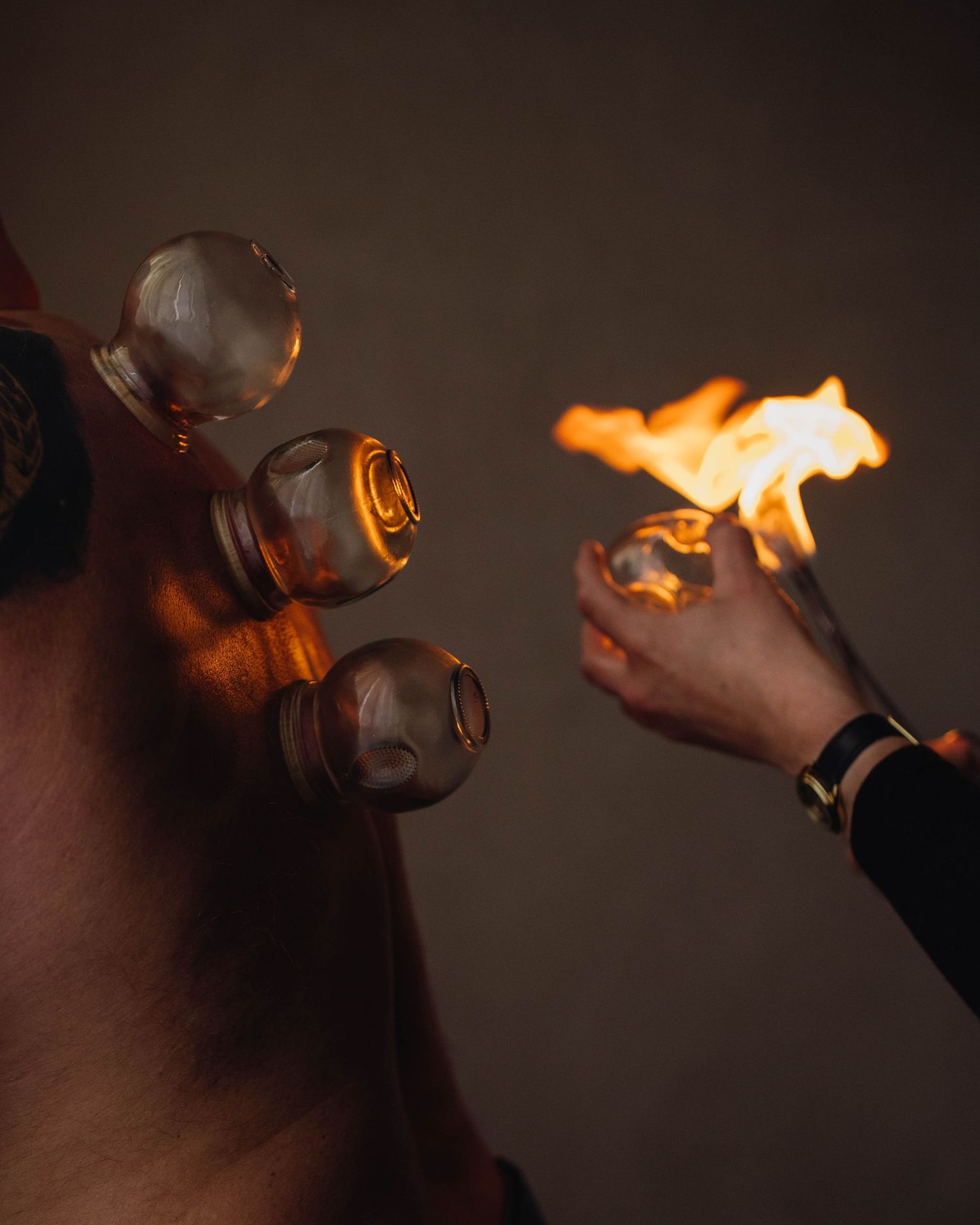 Fire cupping therapy session with glass cups on a person's back, practitioner using flame to create suction.