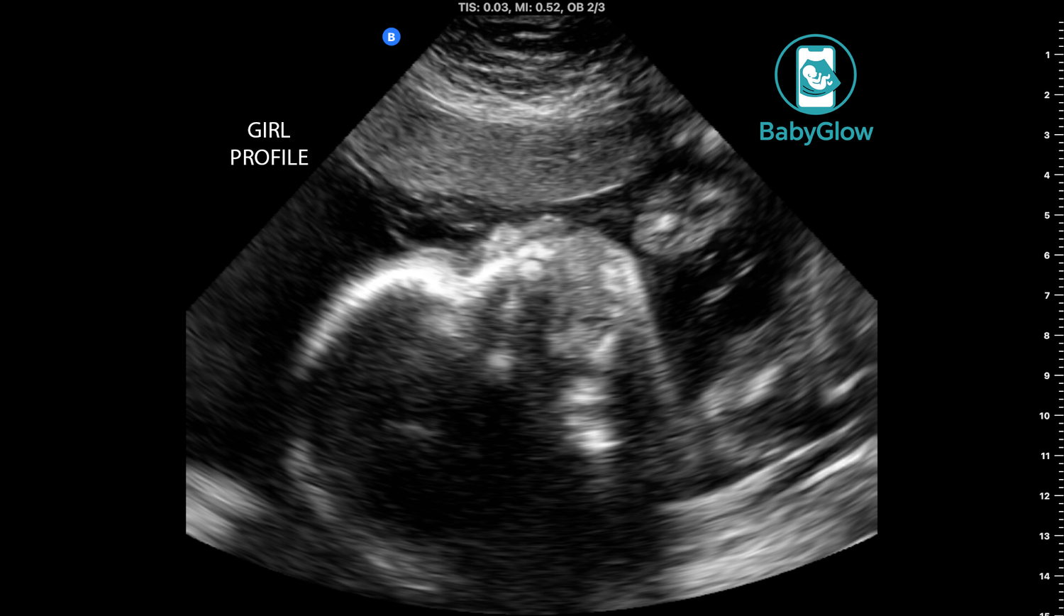 BabyGlow mobile ultrasound scan showing baby girl profile view with clear facial features visible in Winnipeg