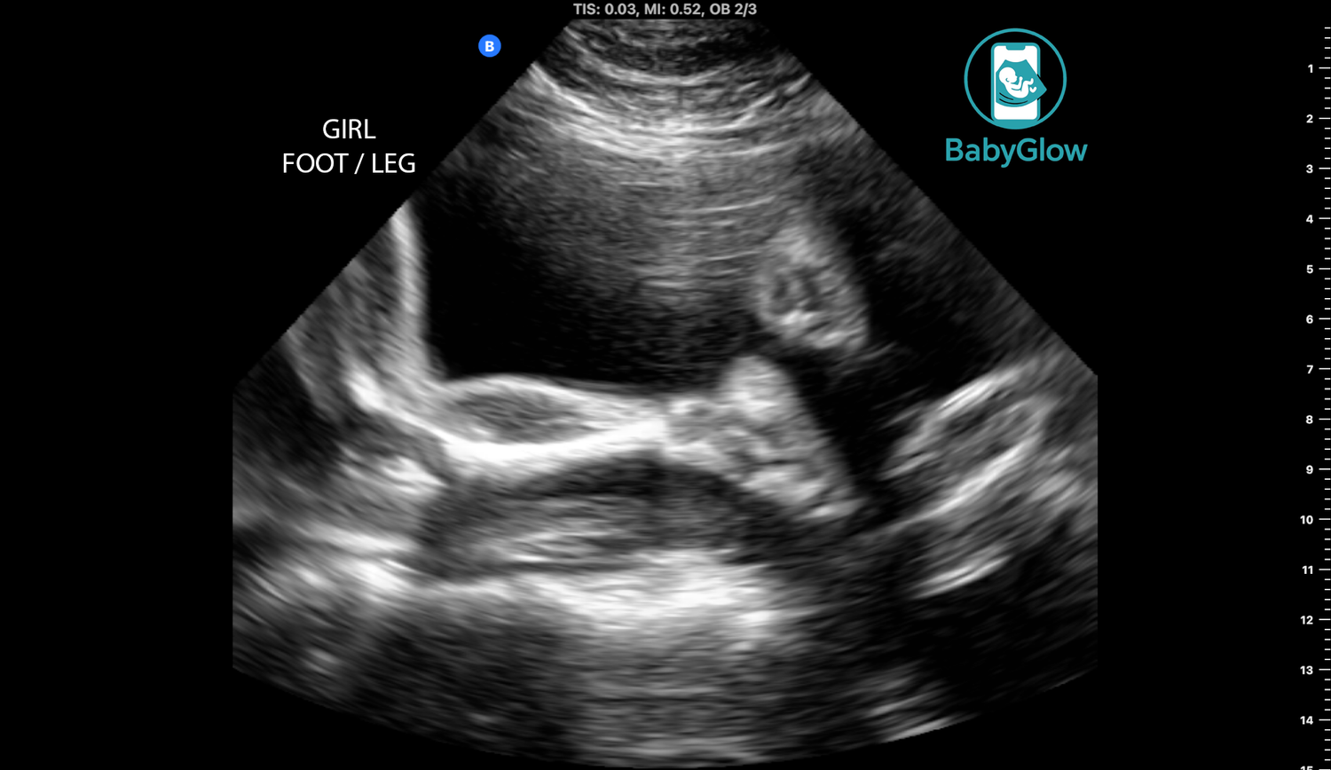 BabyGlow mobile ultrasound scan showing baby girl foot and leg with labeled text overlay in Winnipeg