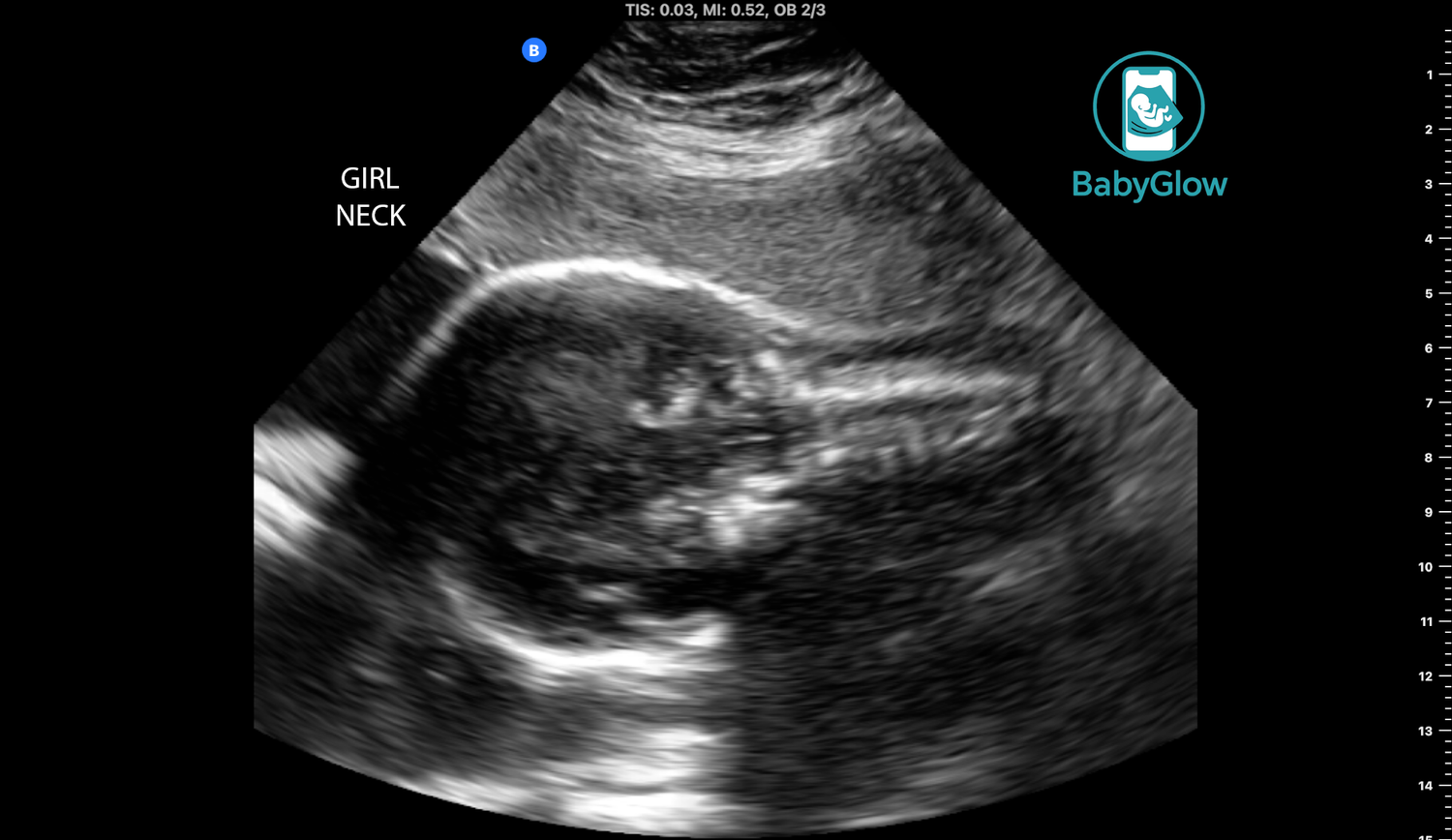 BabyGlow prenatal ultrasound image showing baby girl neck anatomy during mobile ultrasound session in Winnipeg