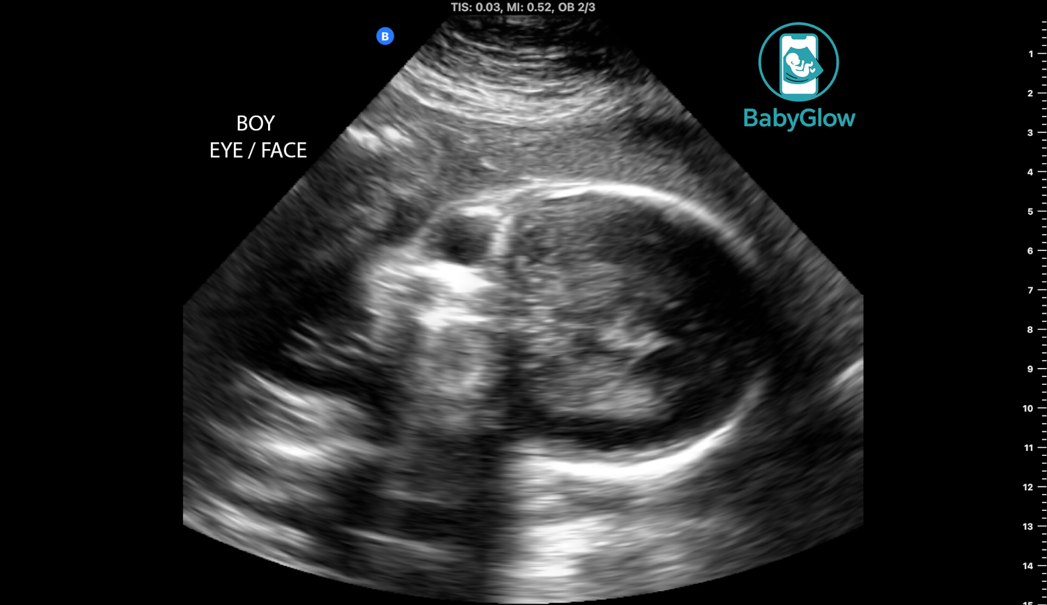 BabyGlow prenatal ultrasound scan showing baby boy eye and face profile view with text label in Winnipeg