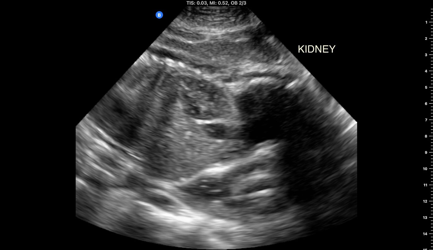 Black and white fetal ultrasound scan showing kidney anatomy labeled on screen in Winnipeg