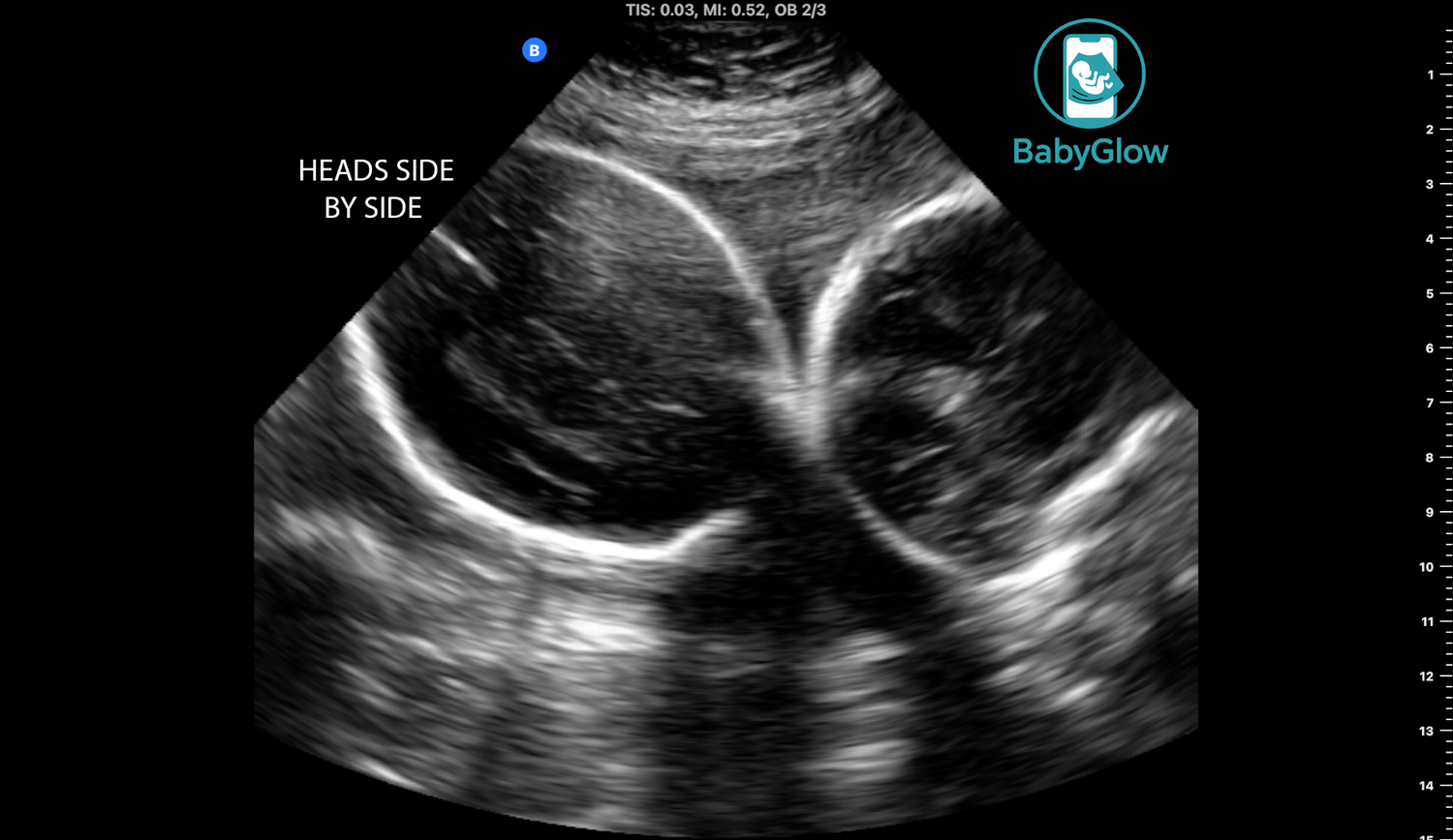BabyGlow ultrasound image showing twin babies heads side by side during prenatal scan in Winnipeg