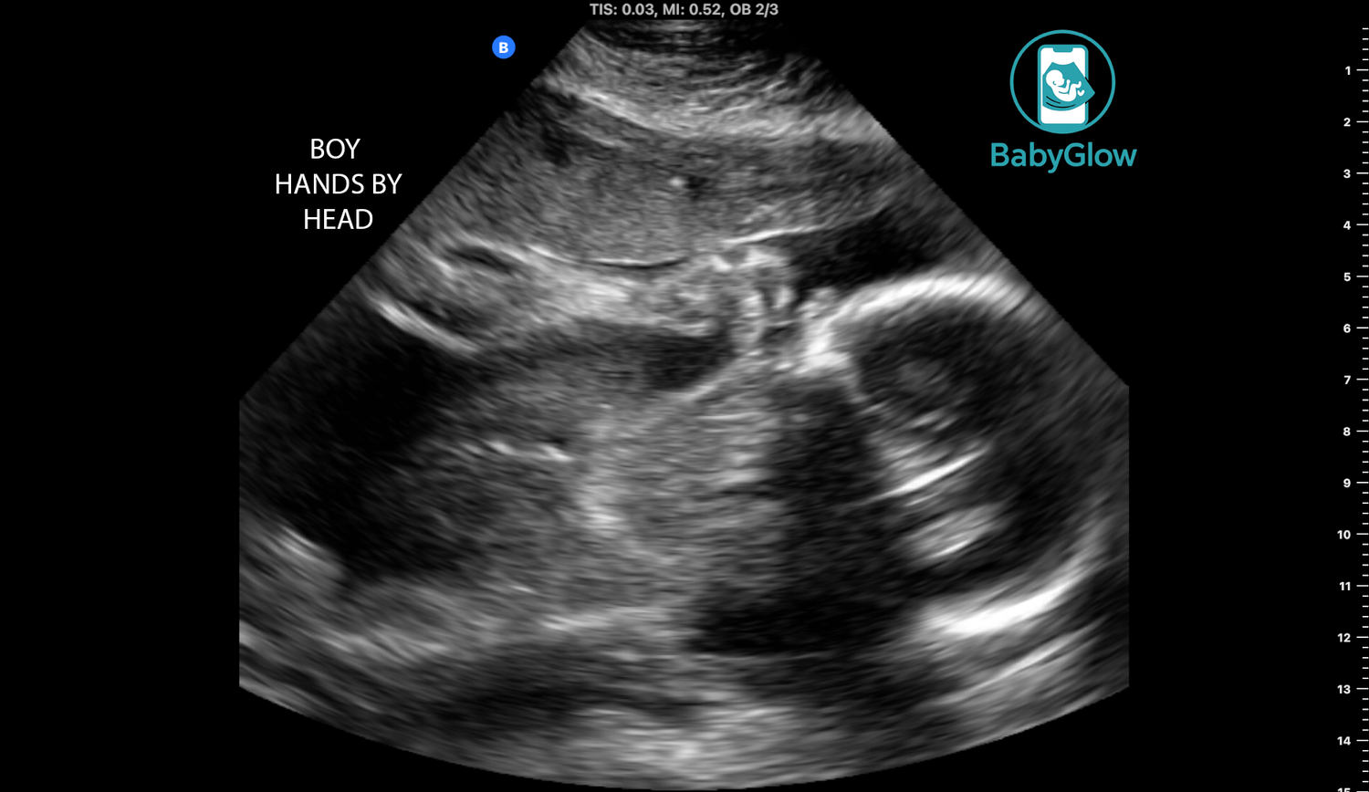 BabyGlow mobile ultrasound image showing baby boy with hands near head, labeled with text overlay in Winnipeg