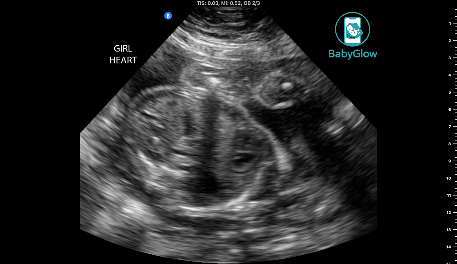 BabyGlow prenatal ultrasound image displaying baby girl heart view with detailed anatomy visible in Winnipeg