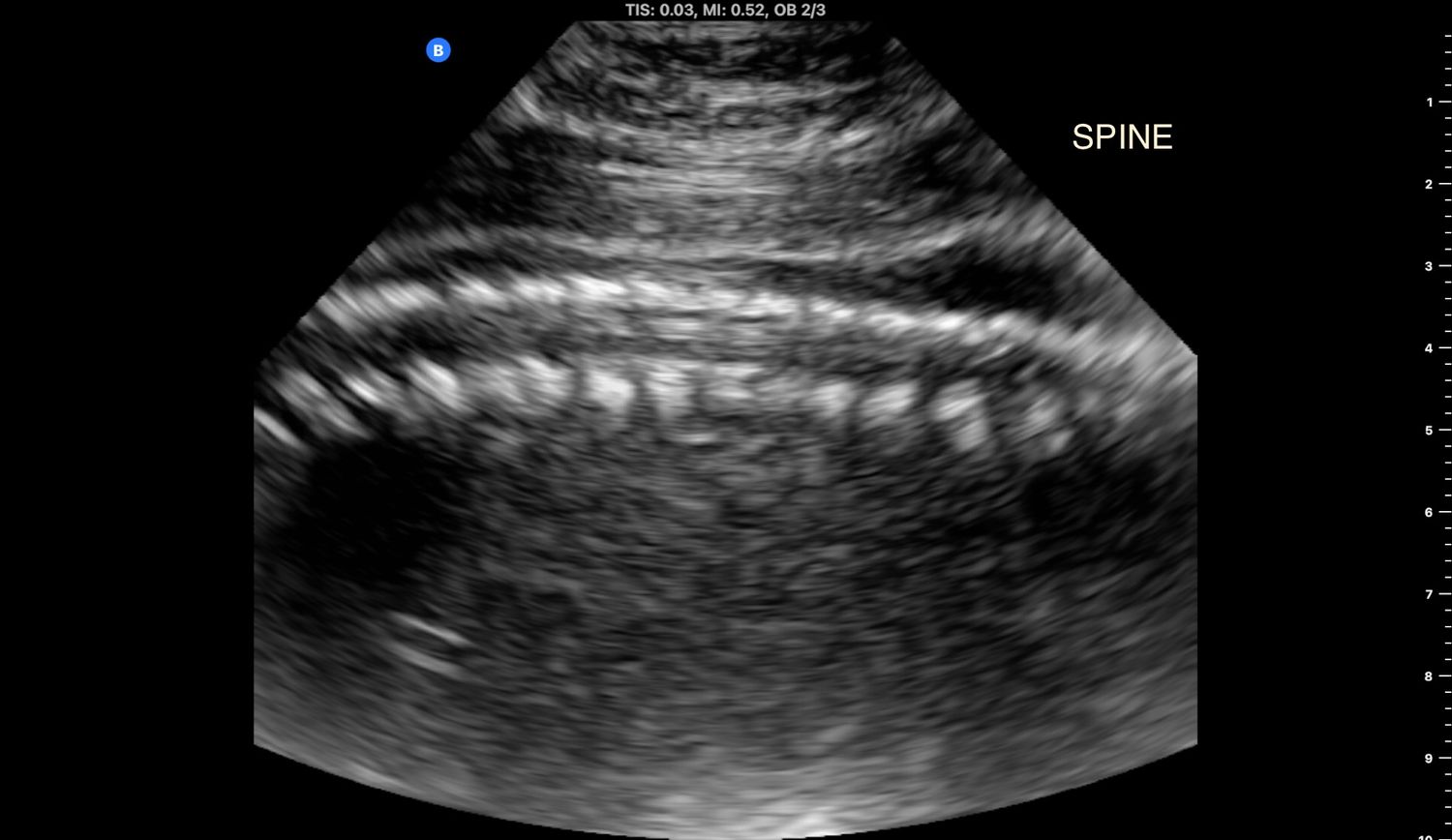 Black and white fetal ultrasound scan showing spine anatomy clearly labeled on screen in Winnipeg