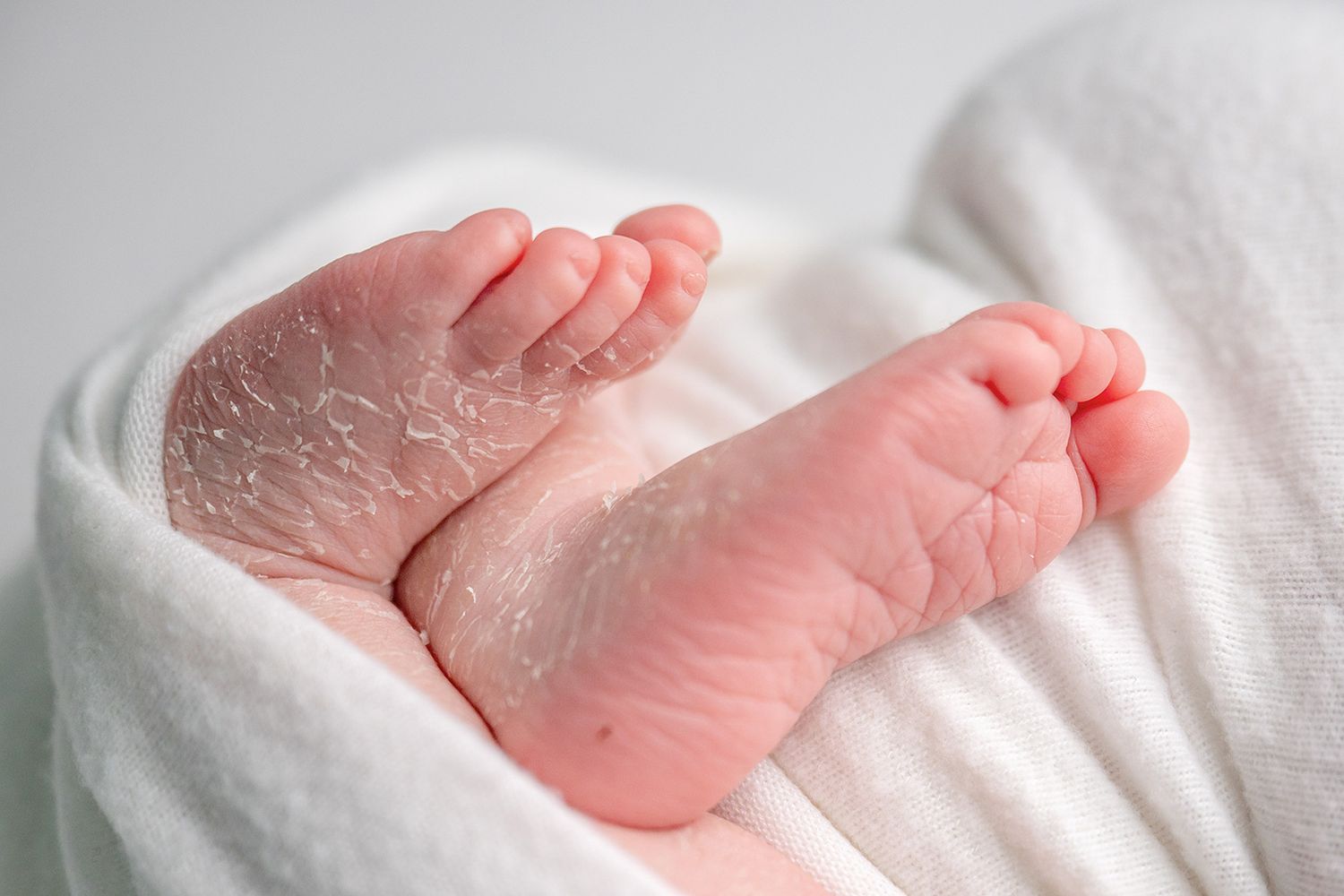 Close-up of newborn baby feet wrapped in a soft white towel, showing natural peeling skin of a recently born infant.