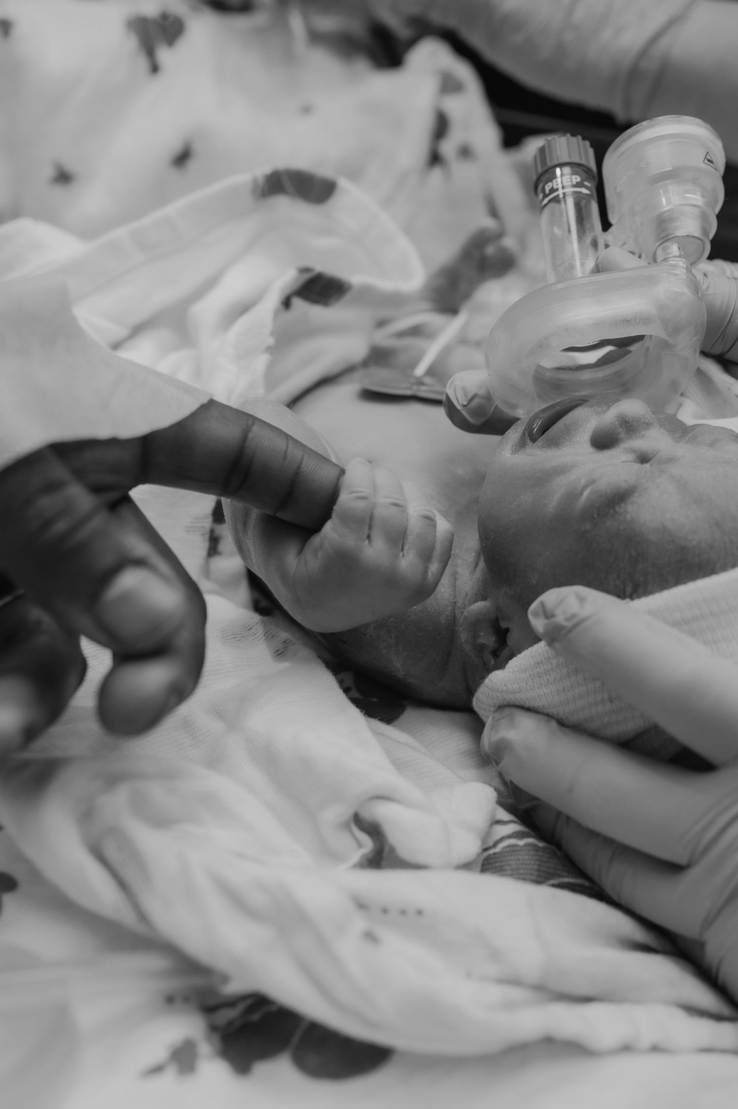 A black and white medical image showing a patient receiving oxygen or respiratory support in a clinical setting.
