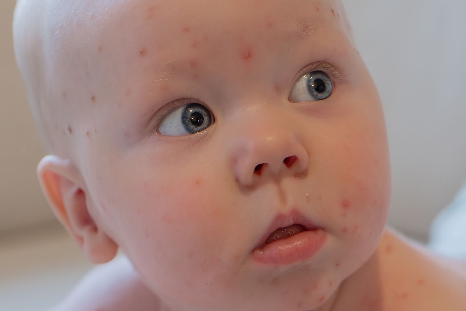 Close-up of a baby with small red spots on face and scalp, possibly a common infant skin rash or chickenpox.