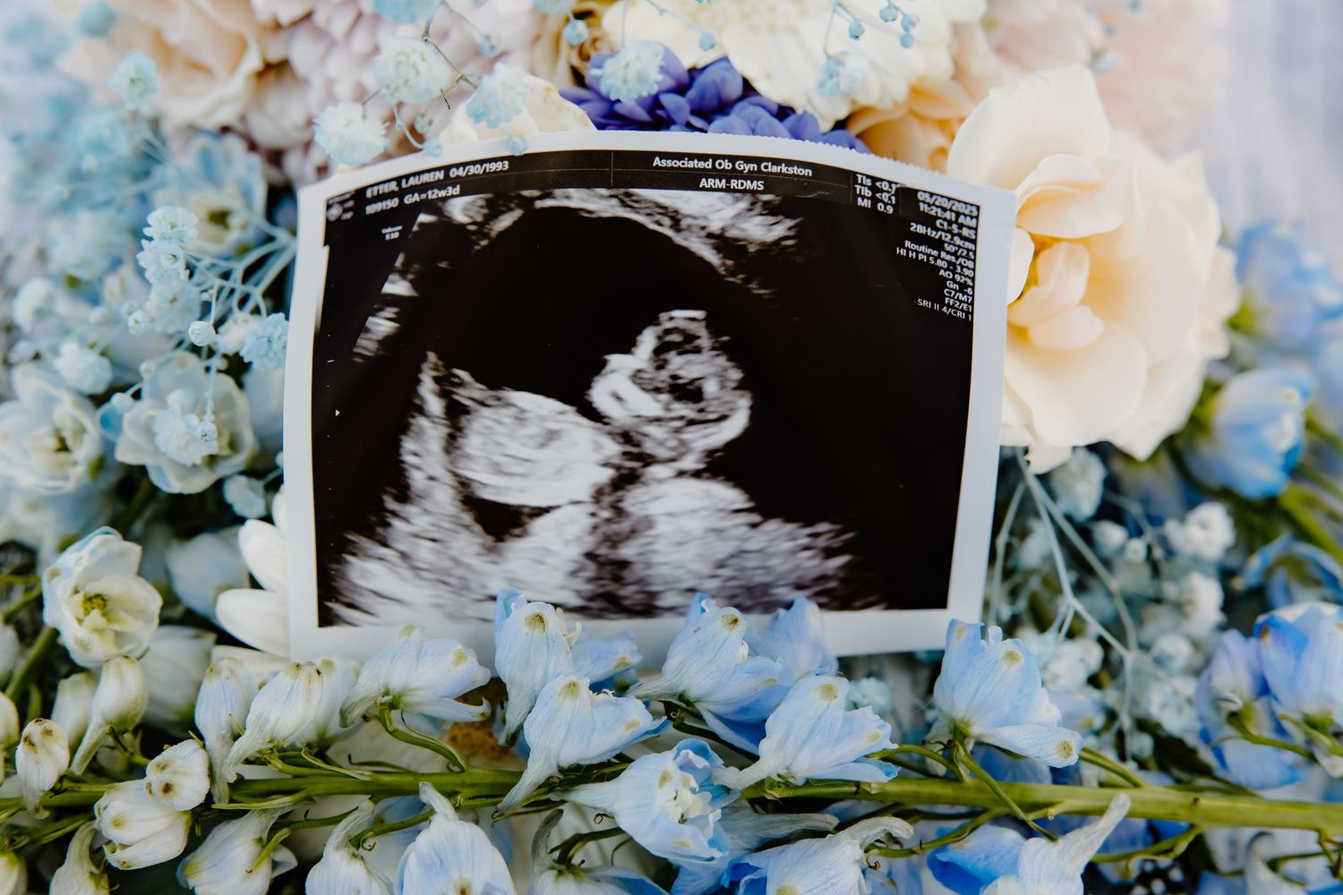 Ultrasound photo displayed with delicate blue and white floral arrangement.