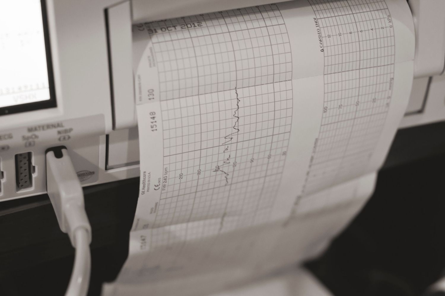 A close-up of medical monitoring equipment showing fetal heart rate and contraction patterns.