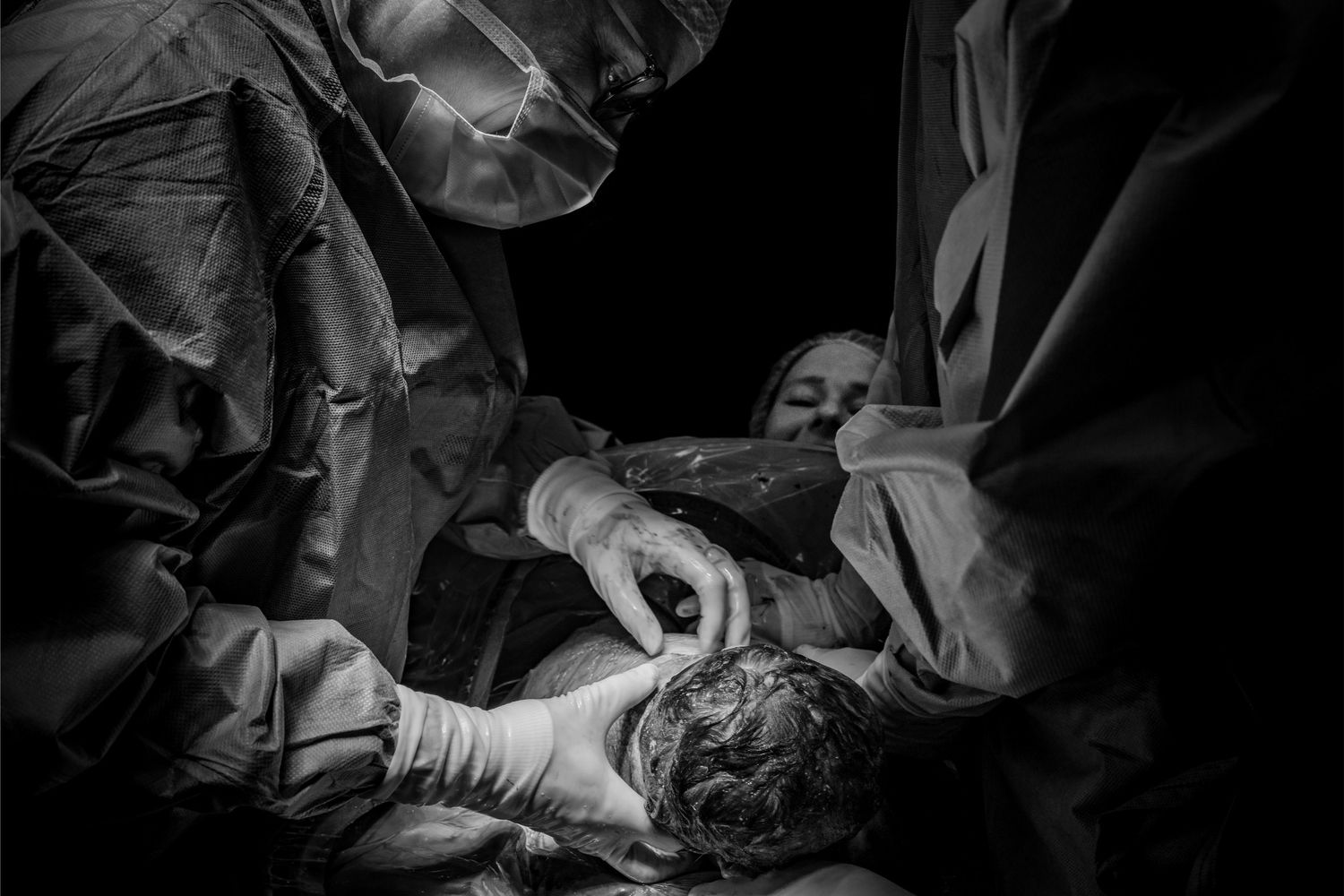 Black and white photo capturing the dramatic moment of a baby being delivered during a cesarean section surgery.