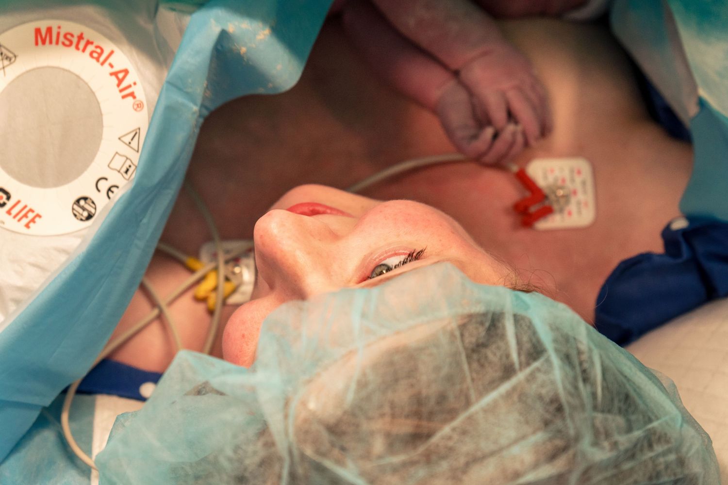 A mother lies awake on the operating table during a cesarean section with medical monitors attached.