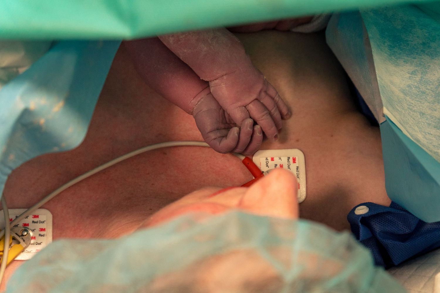 Newborn baby's hand visible during cesarean section surgery in operating room.