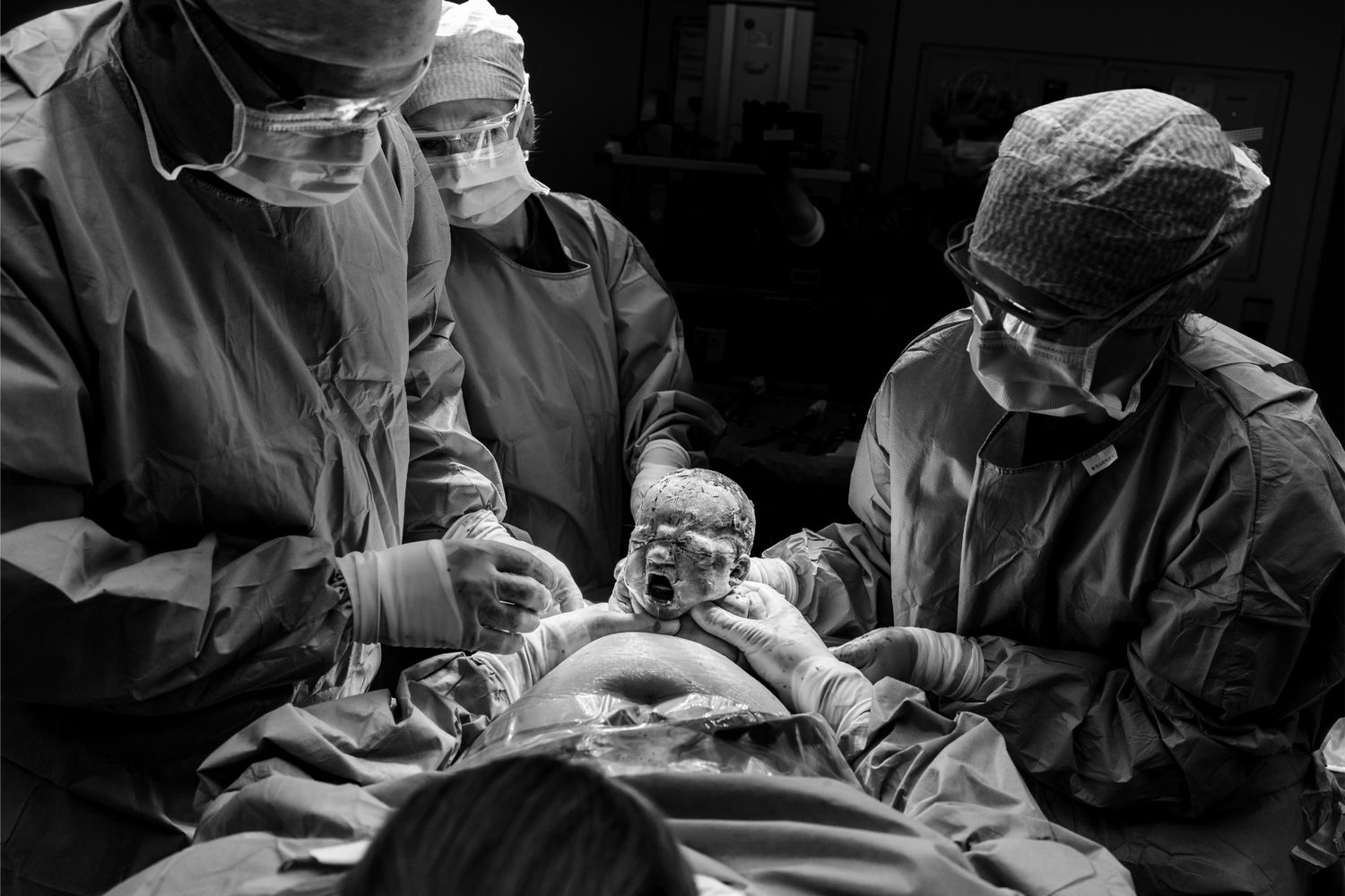 Medical team carefully handling newborn baby during cesarean delivery in operating room.