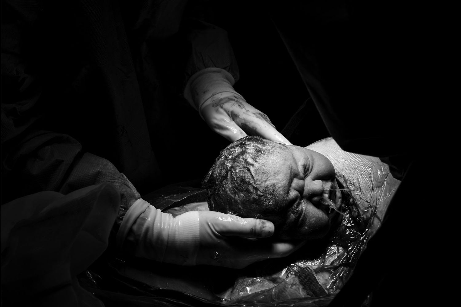 Black and white photo of gloved hands carefully cradling a newborn baby's head during cesarean delivery.