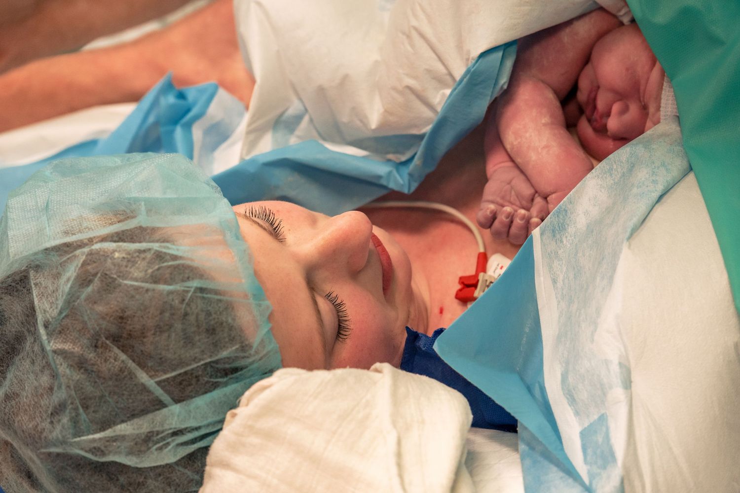 A newborn baby is placed on the chest of a mother immediately after a cesarean section delivery. Birth photography by Constanze Ariane