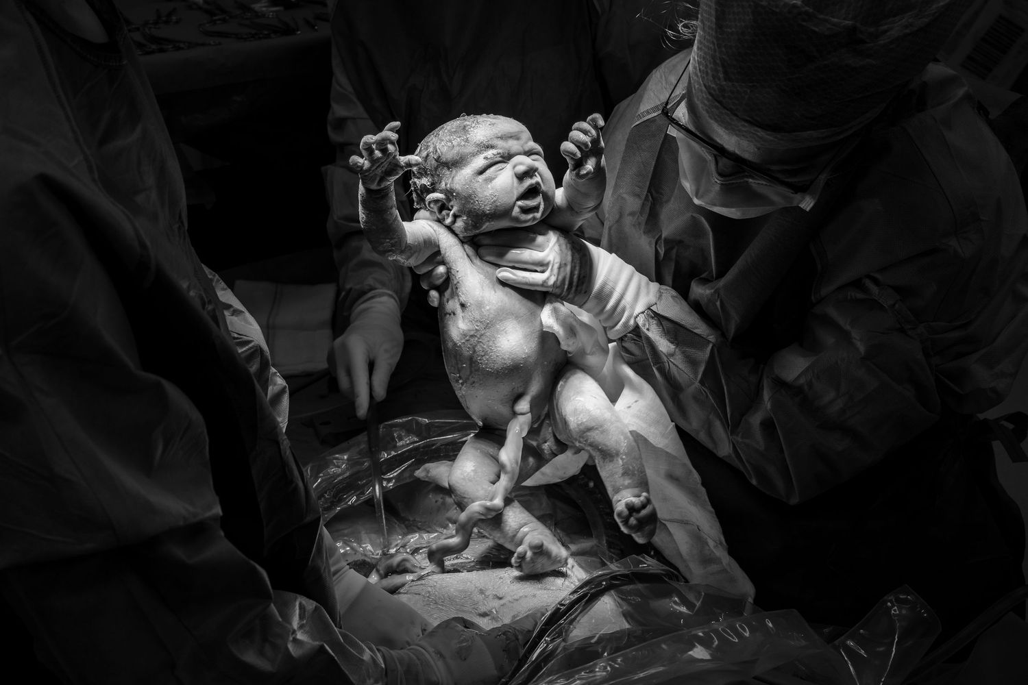 A newborn baby cries as medical staff lift it during a cesarean section birth in black and white.