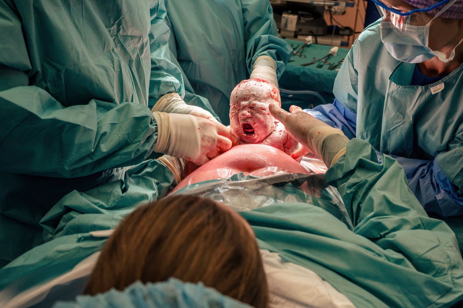 Medical team lifting newborn baby during cesarean section delivery in operating room.