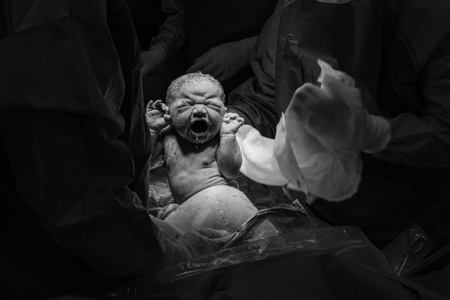 Newborn baby crying immediately after birth during cesarean section delivery.