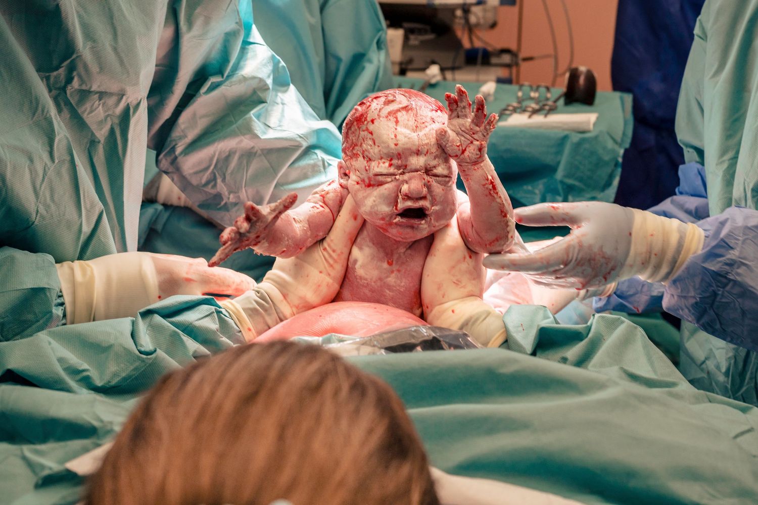 Medical team delivering newborn baby during cesarean section in hospital operating room. Birth photography by Constanze Ariane