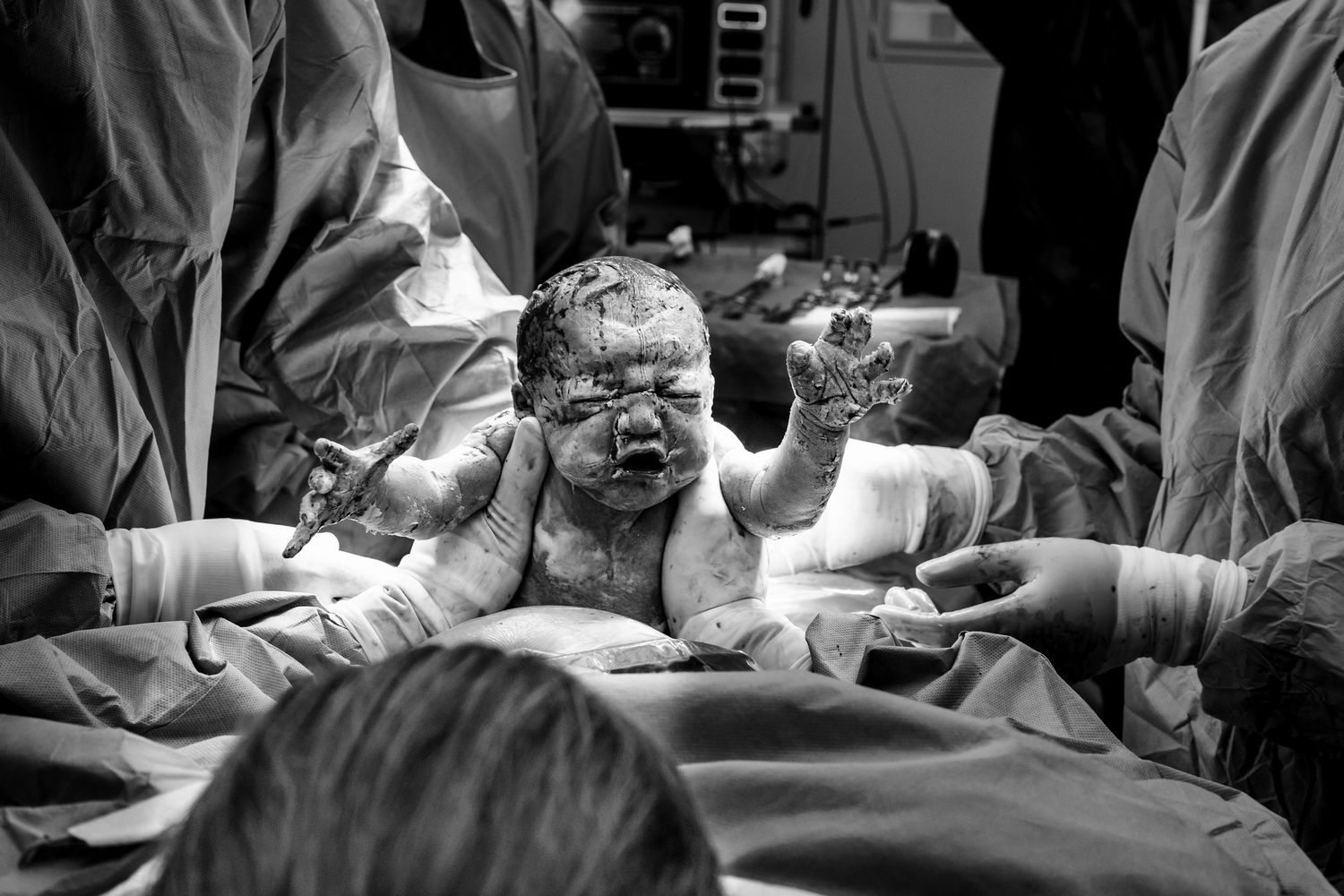 Black and white photo of a newborn baby being delivered by medical staff in an operating room.