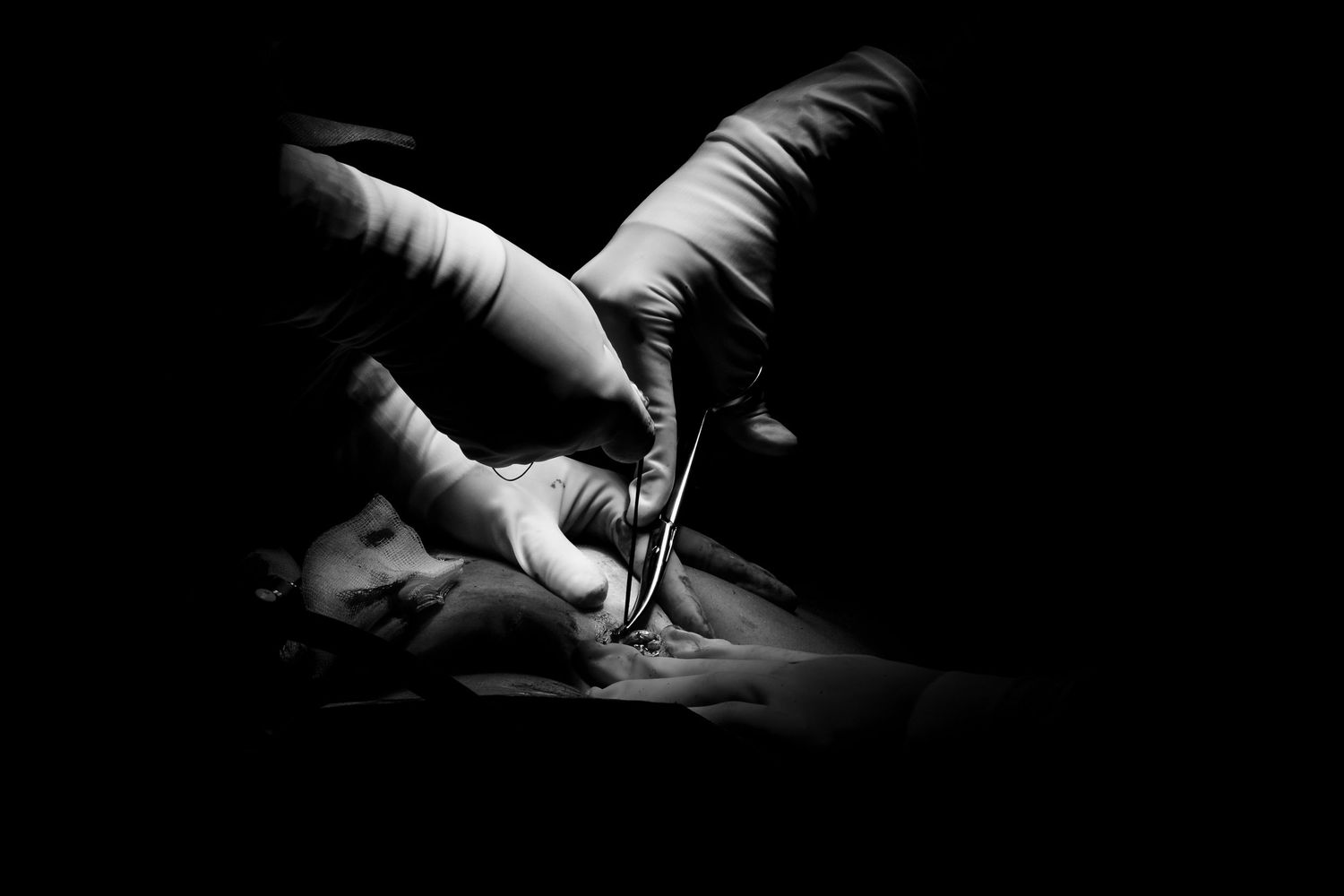 Gloved hands performing surgery with medical instrument on patient in dark OR.