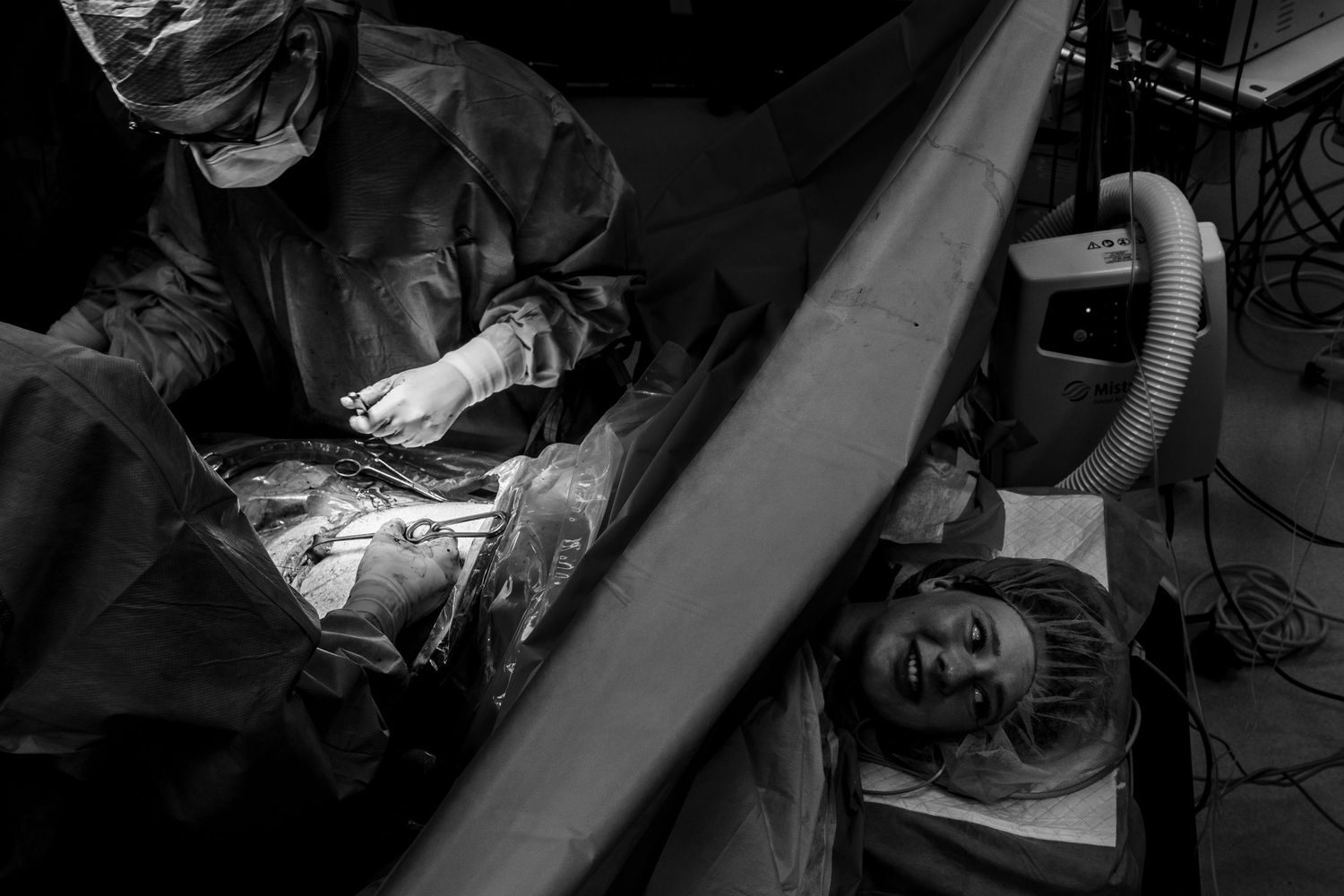 A black and white photo of a surgeon performing a C-section while the mother lies awake on the table.