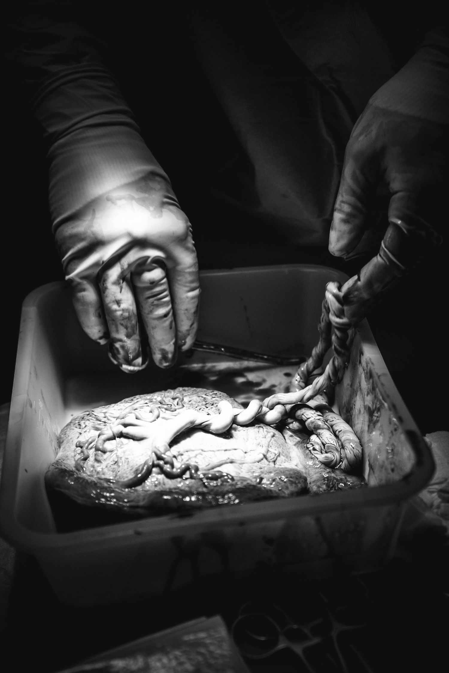 Black and white close-up of gloved medical hands handling a placenta in a hospital basin.