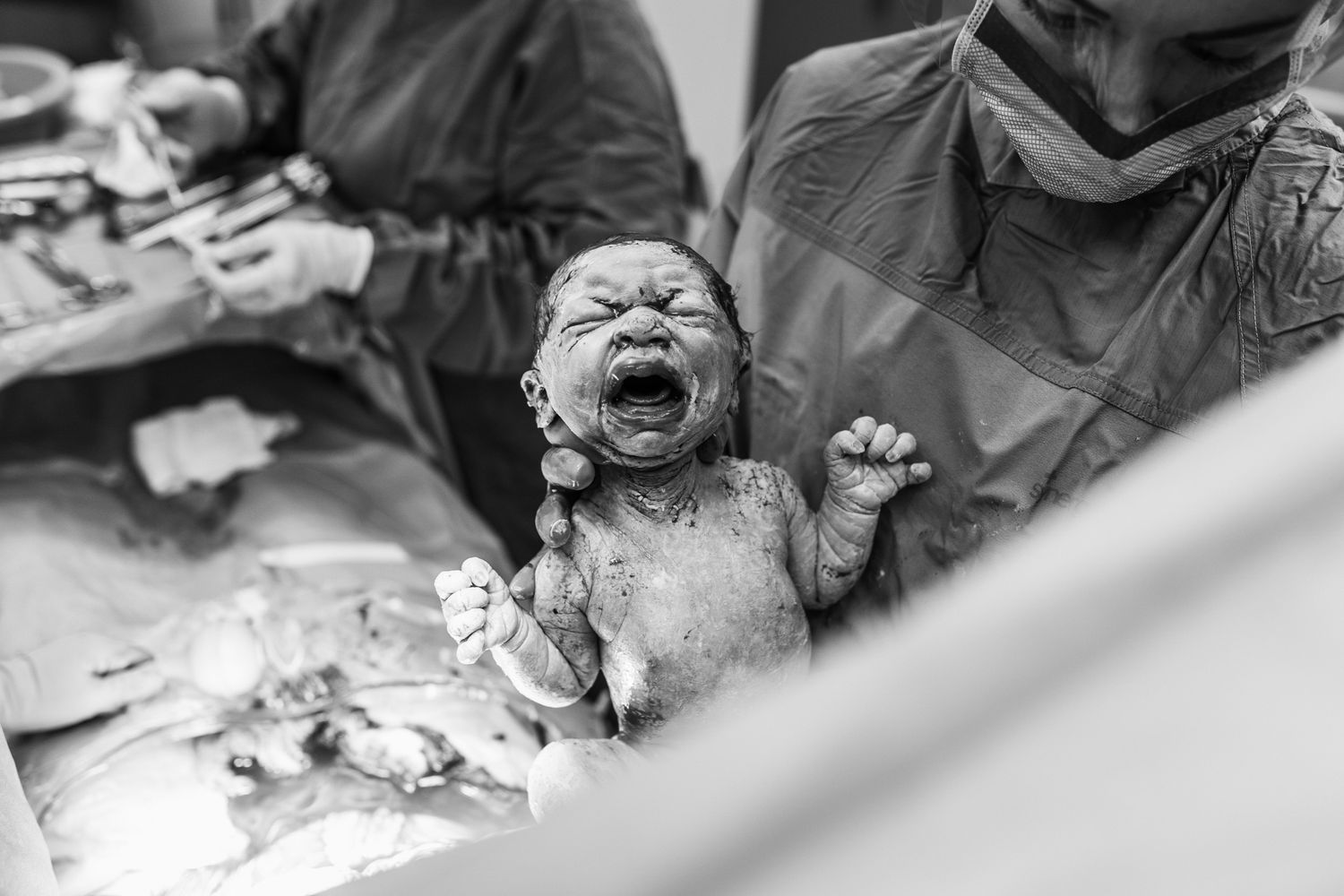 Caesarean birth captured by a Dubai birth photographer